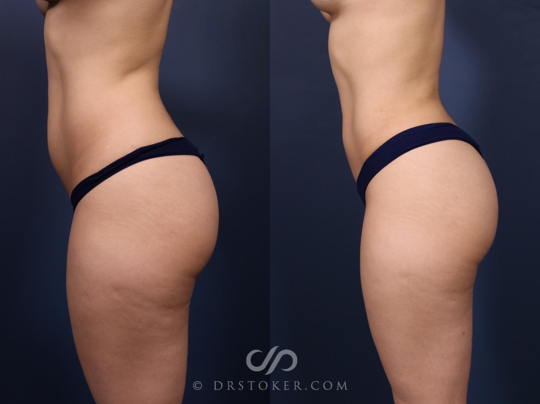 Before & After Liposuction Case 2575 Left Side View in Los Angeles, CA