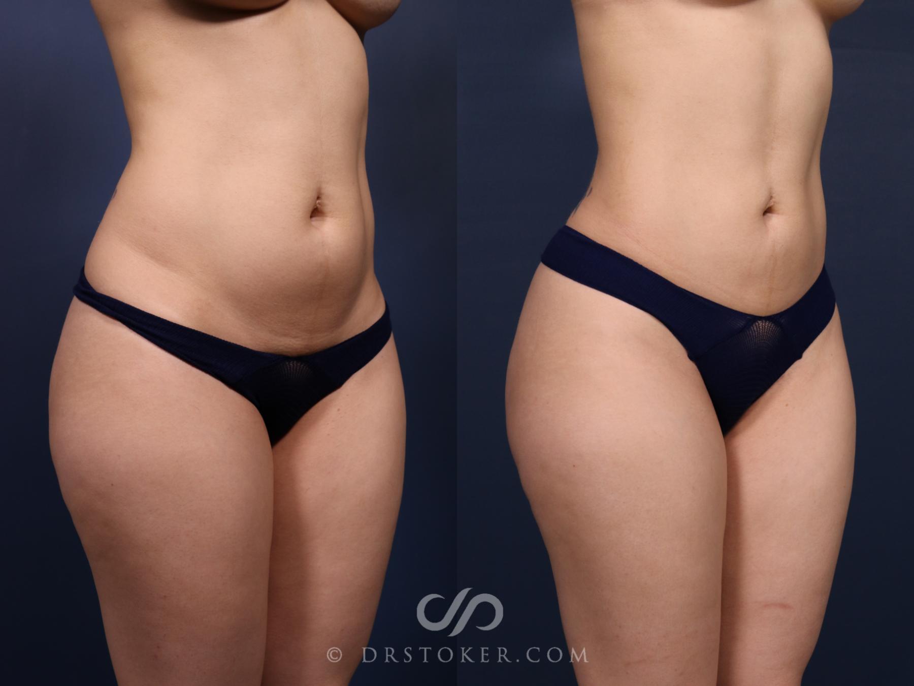 Before & After Liposuction Case 2575 Right Oblique View in Los Angeles, CA