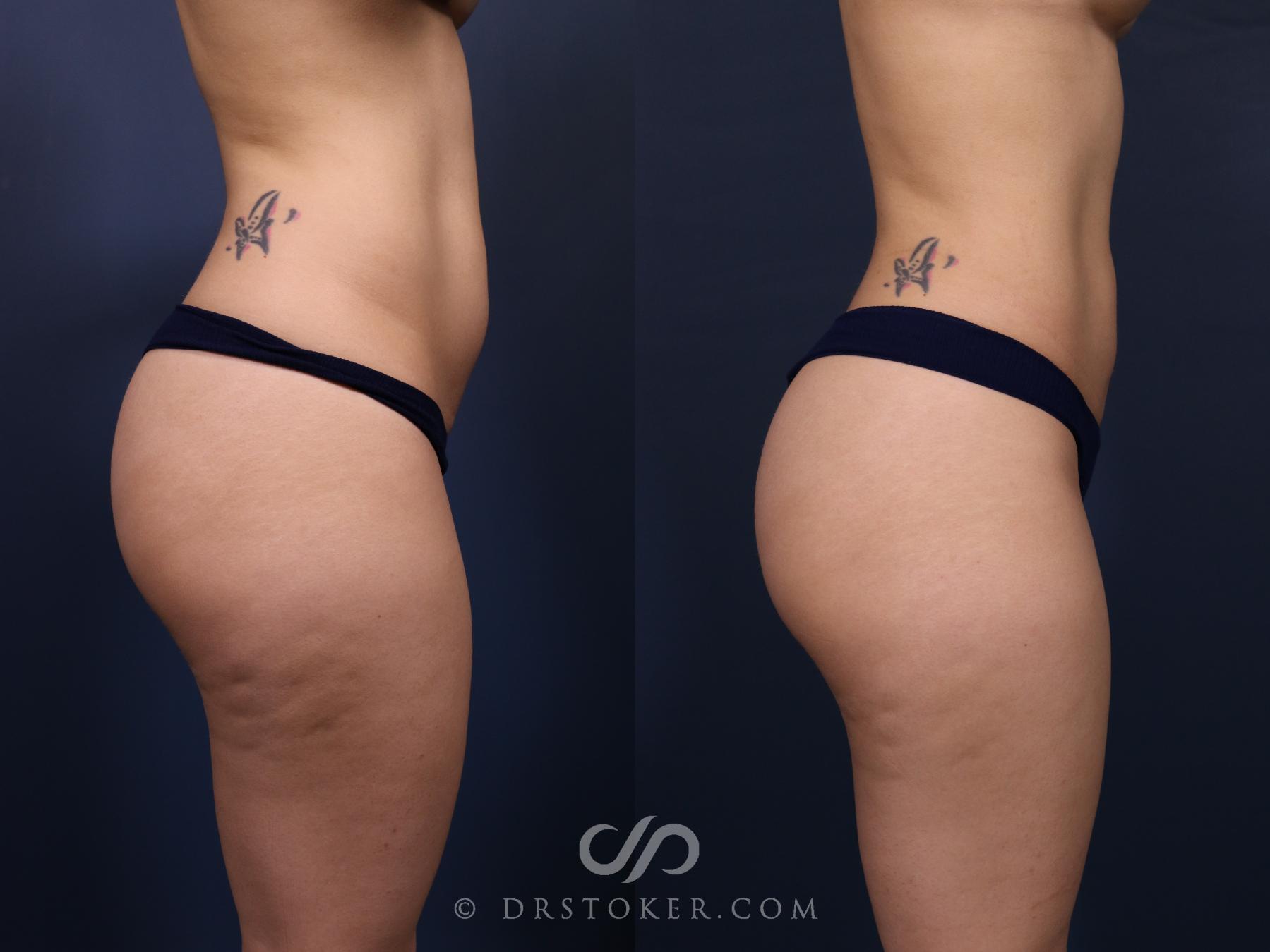 Before & After Liposuction Case 2575 Right Side View in Los Angeles, CA