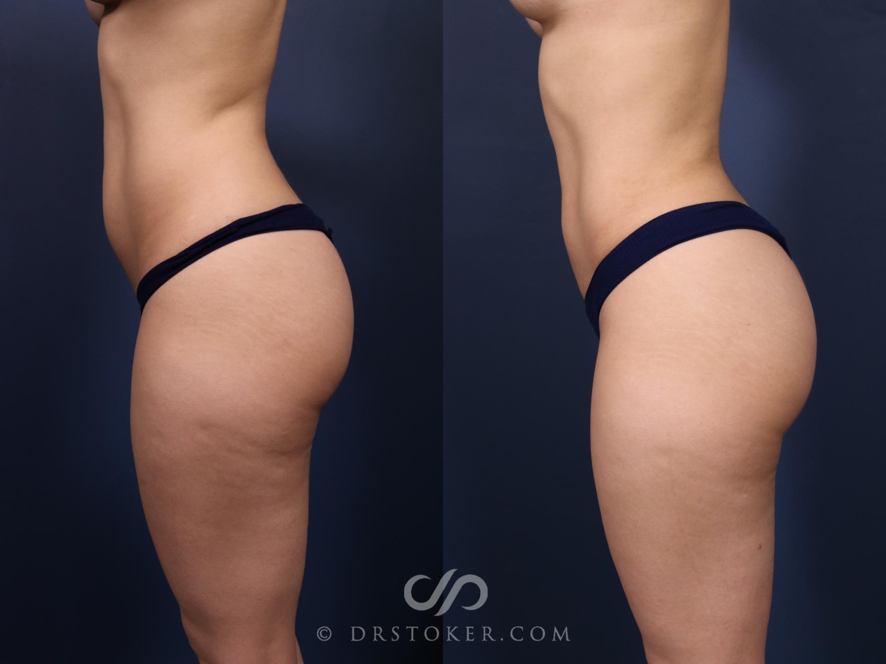Before & After Liposuction Case 2576 Left Side View in Los Angeles, CA