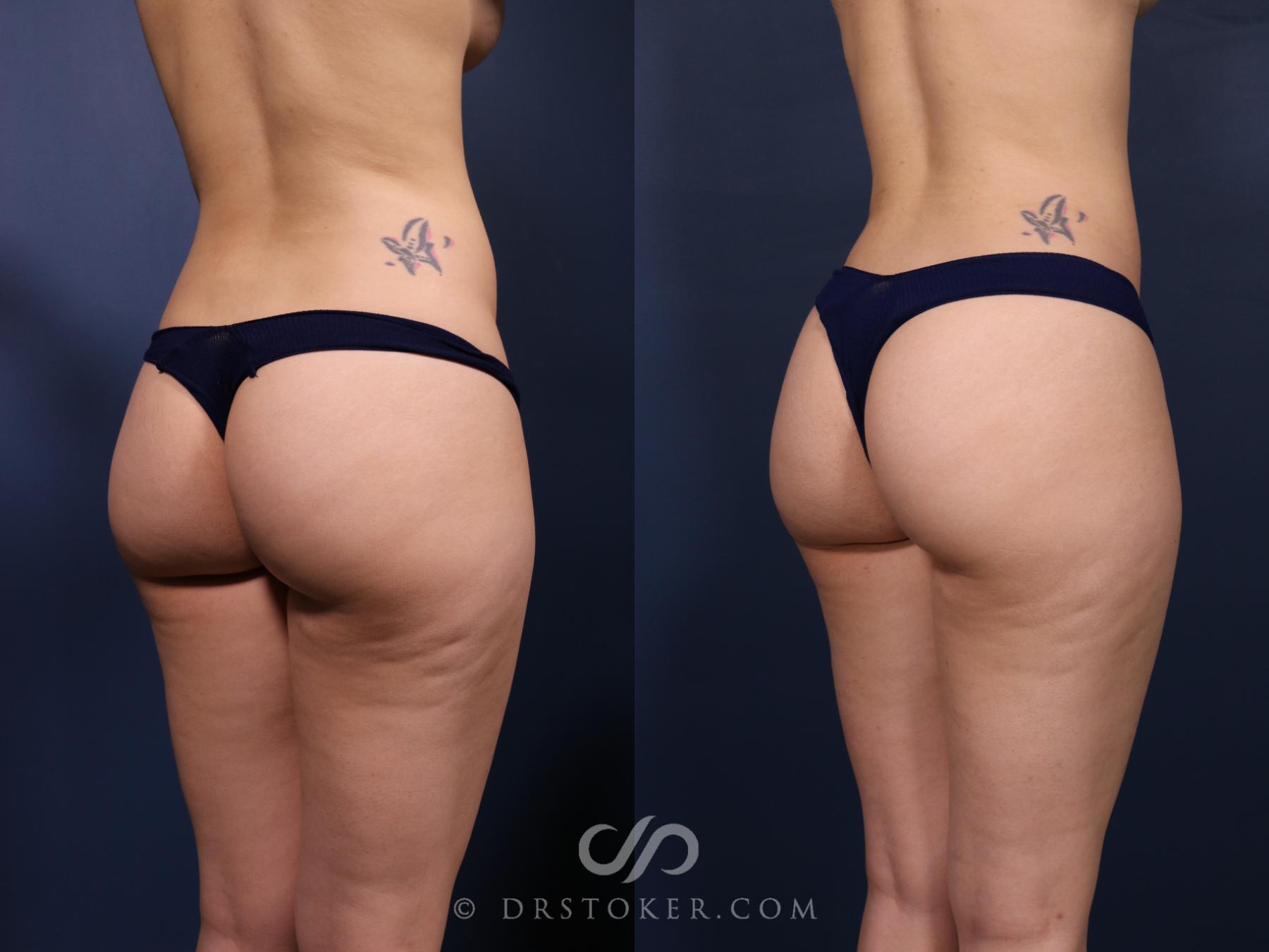 Before & After Liposuction Case 2576 Right Oblique View in Los Angeles, CA