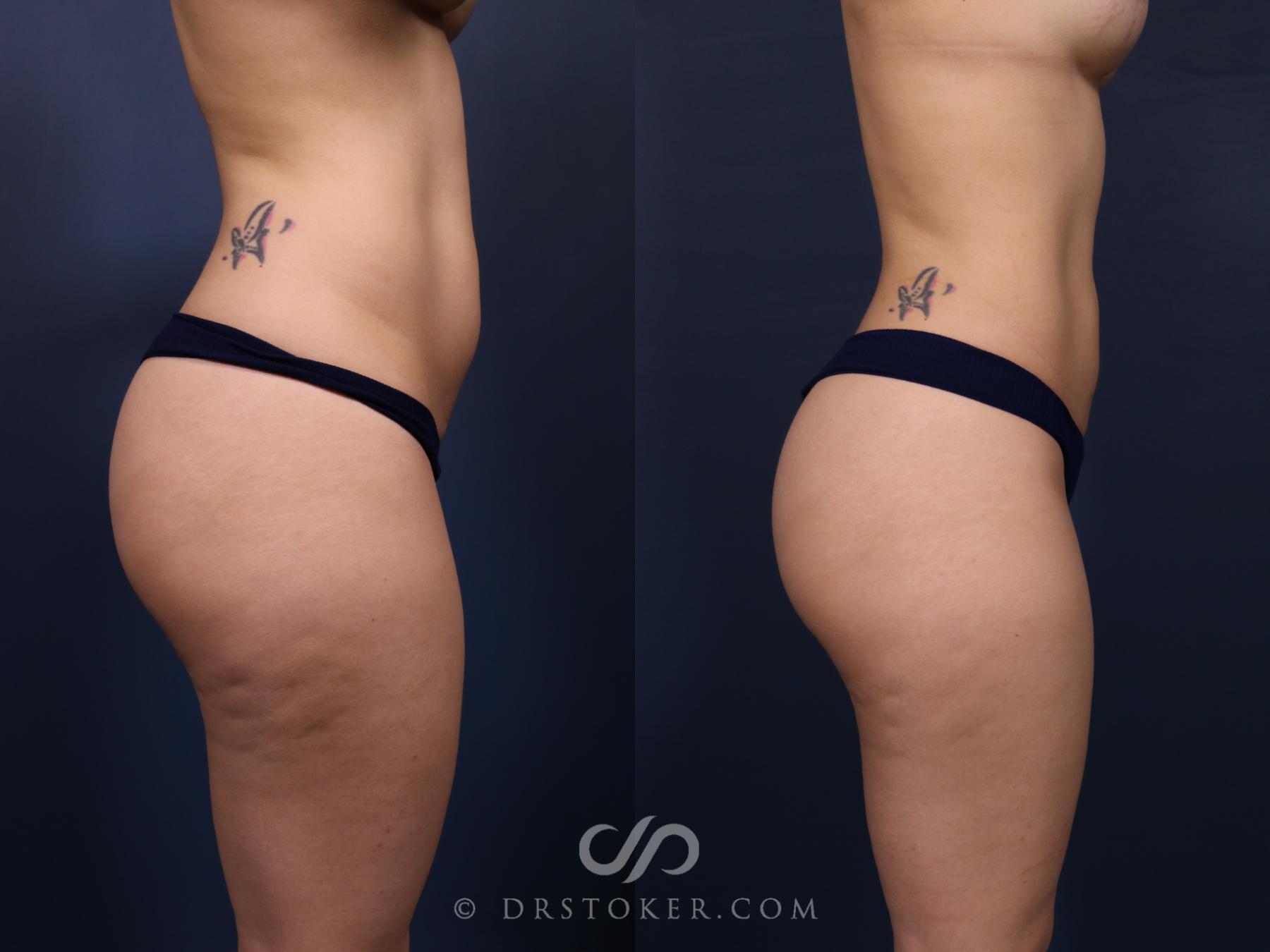Before & After Liposuction Case 2576 Right Side View in Los Angeles, CA