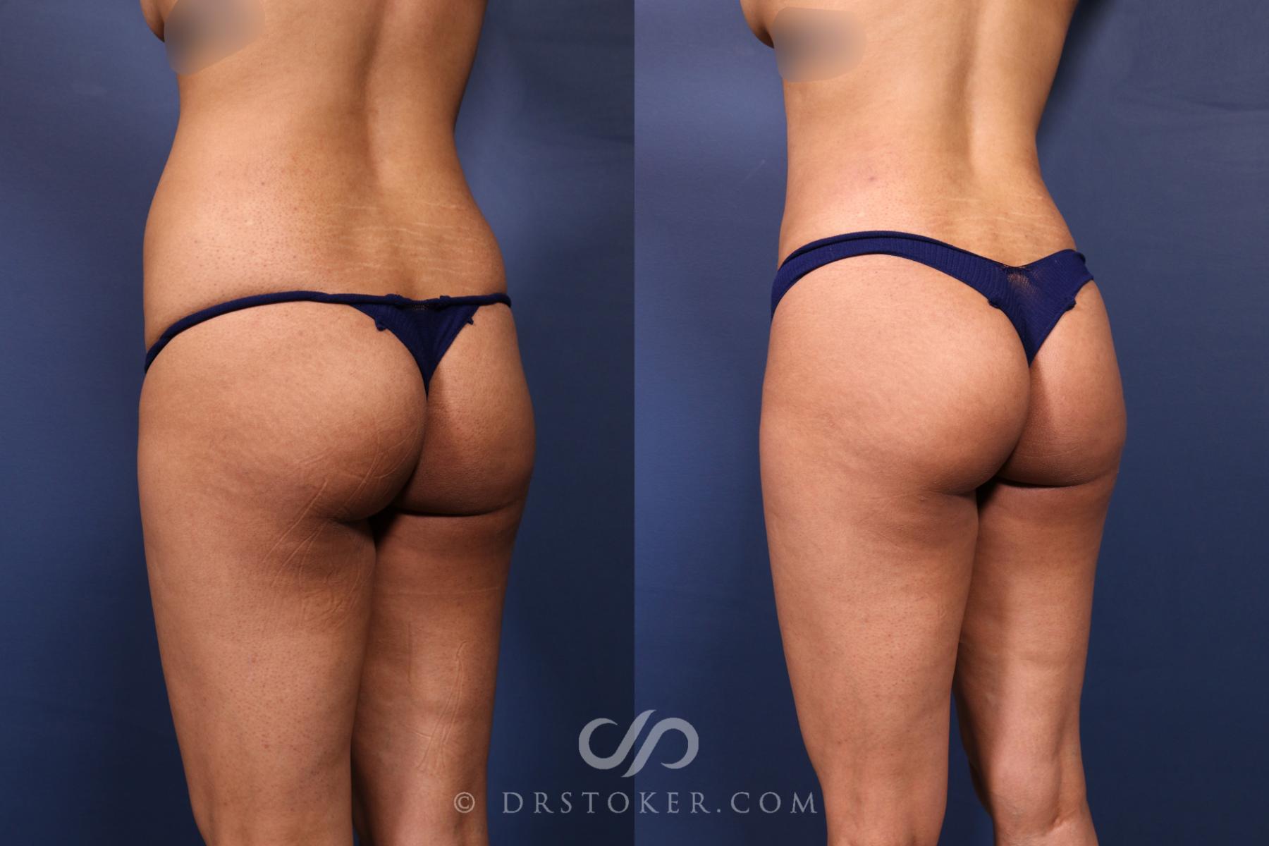 Before & After Liposuction Case 2611 Back Left Oblique View in Los Angeles, CA