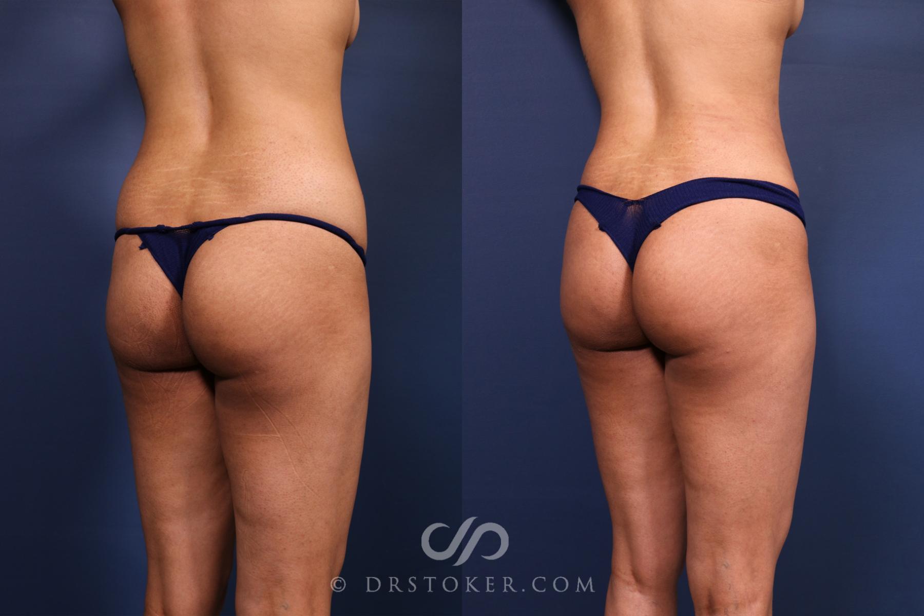 Before & After Liposuction Case 2611 Back Right Oblique View in Los Angeles, CA
