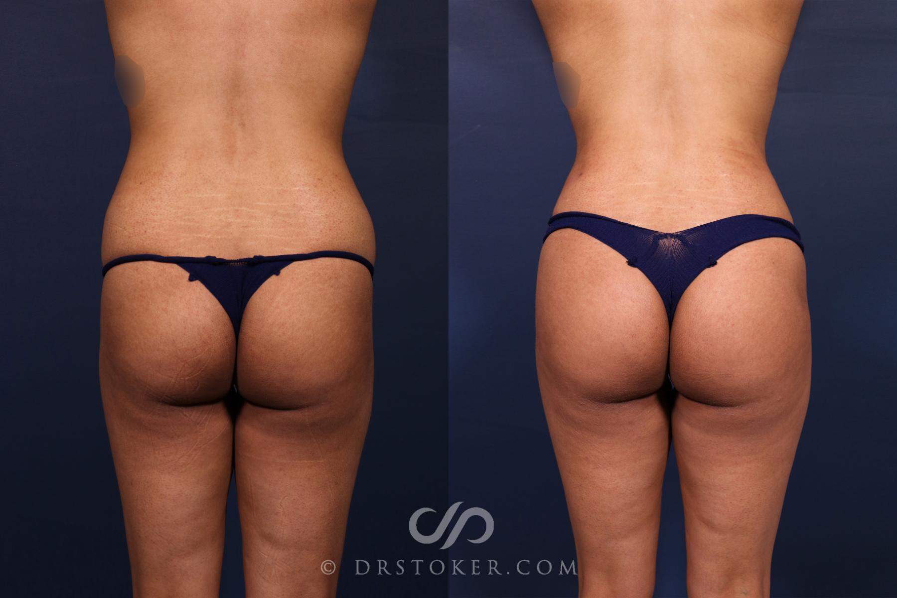 Before & After Liposuction Case 2611 Back View in Los Angeles, CA
