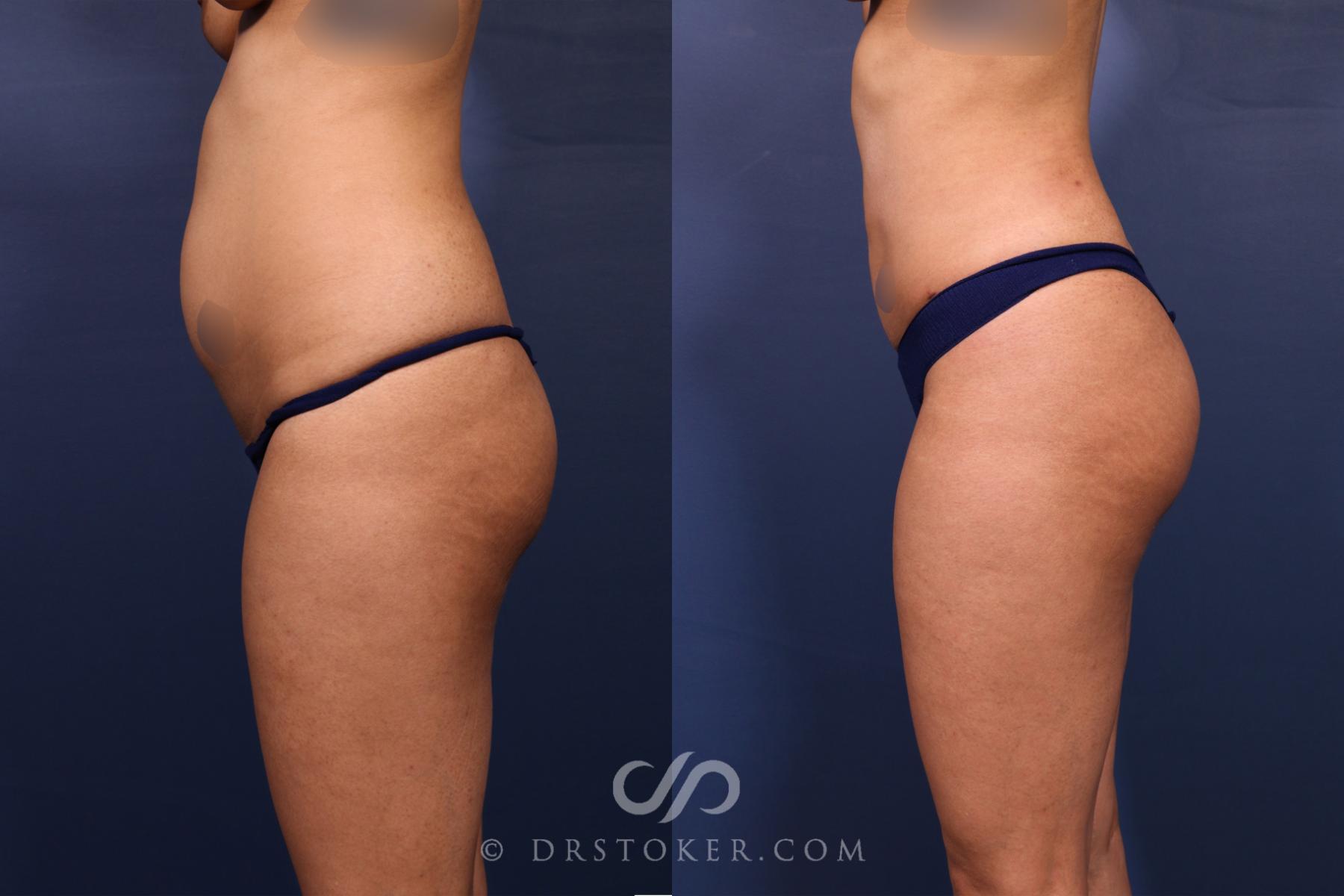 Before & After Liposuction Case 2611 Left Side View in Los Angeles, CA