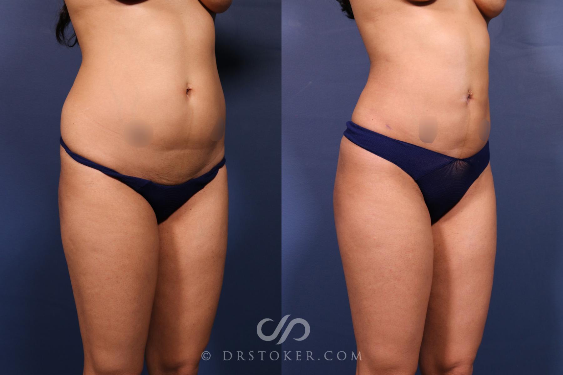 Before & After Liposuction Case 2611 Right Oblique View in Los Angeles, CA