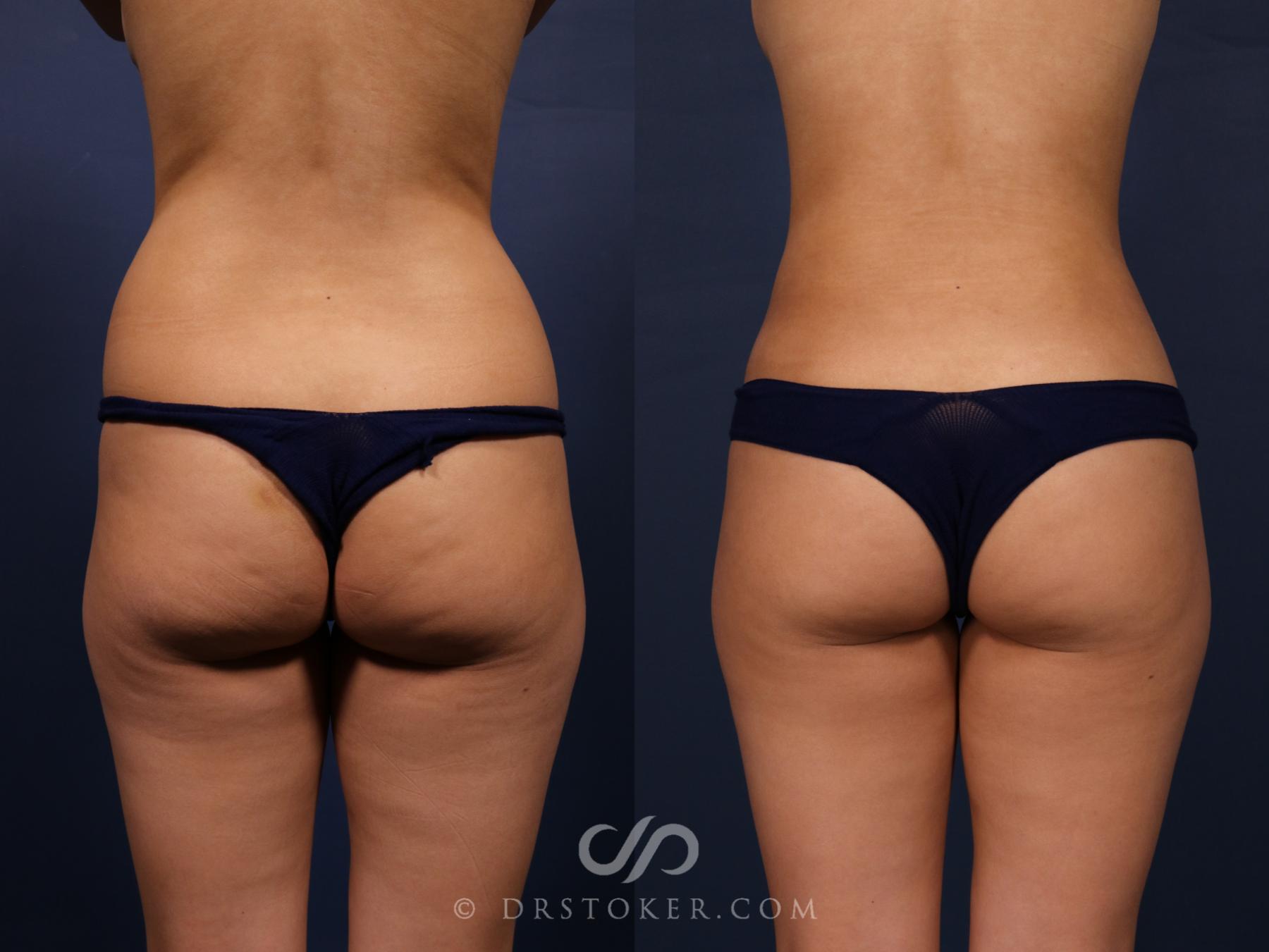 Before & After Liposuction Case 2654 Back View in Los Angeles, CA