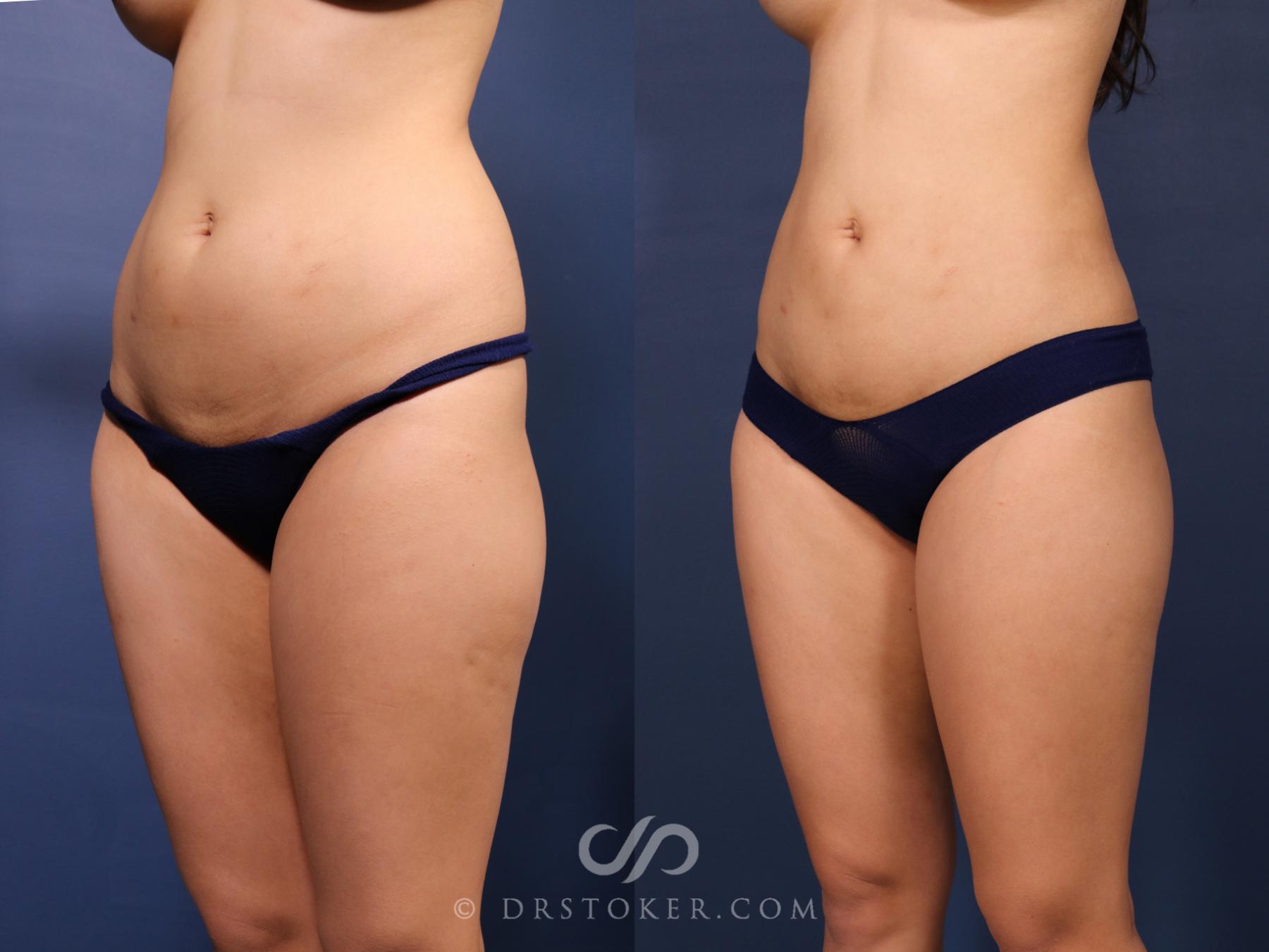 Before & After Liposuction Case 2654 Left Oblique View in Los Angeles, CA