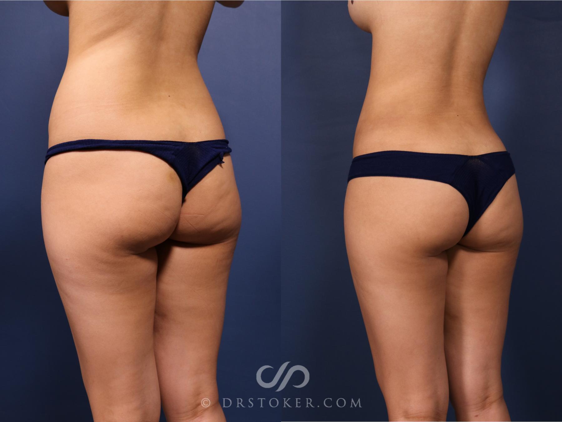 Before & After Liposuction Case 2656 Back Left Oblique View in Los Angeles, CA