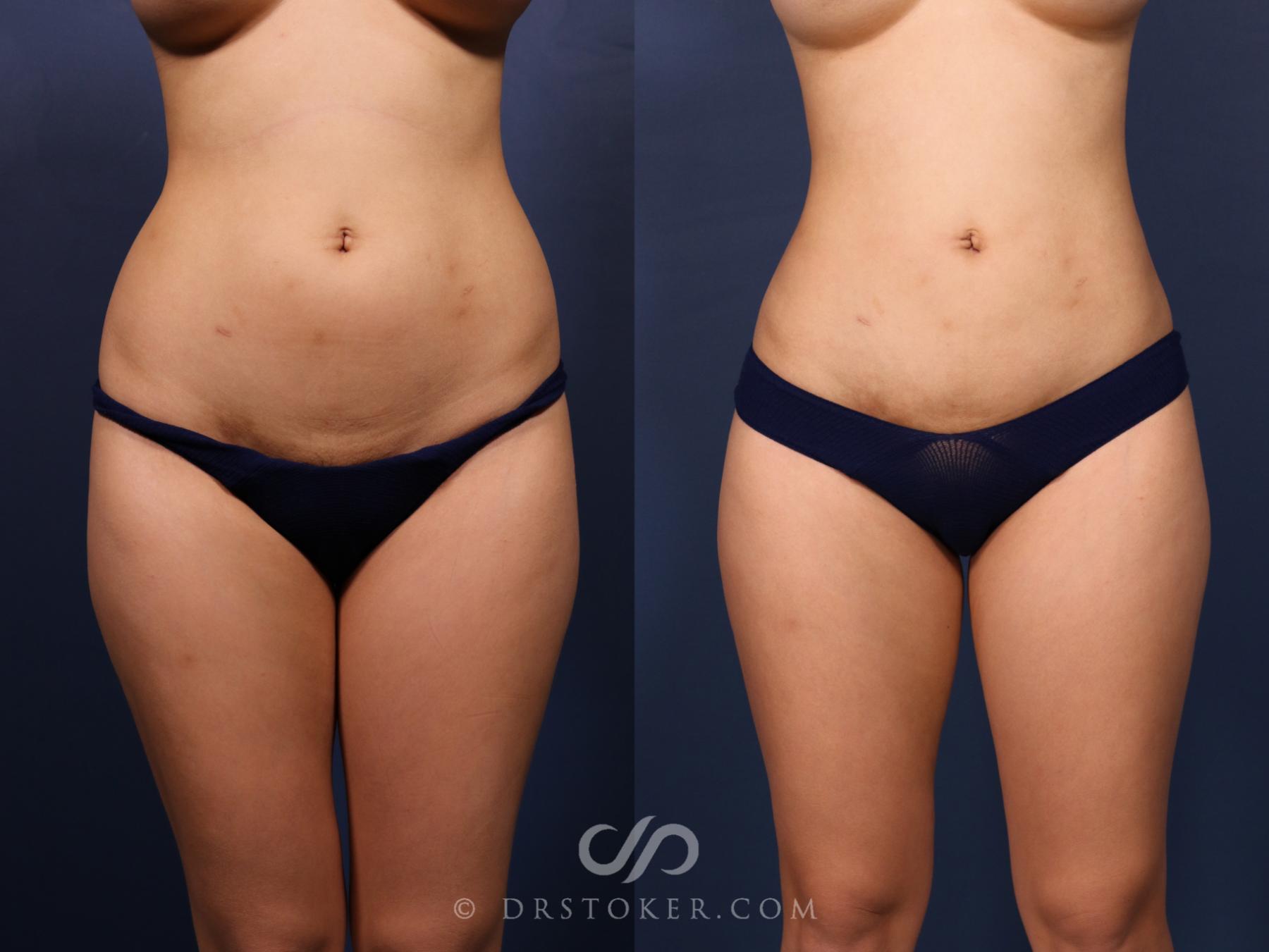 Before & After Liposuction Case 2656 Front View in Los Angeles, CA