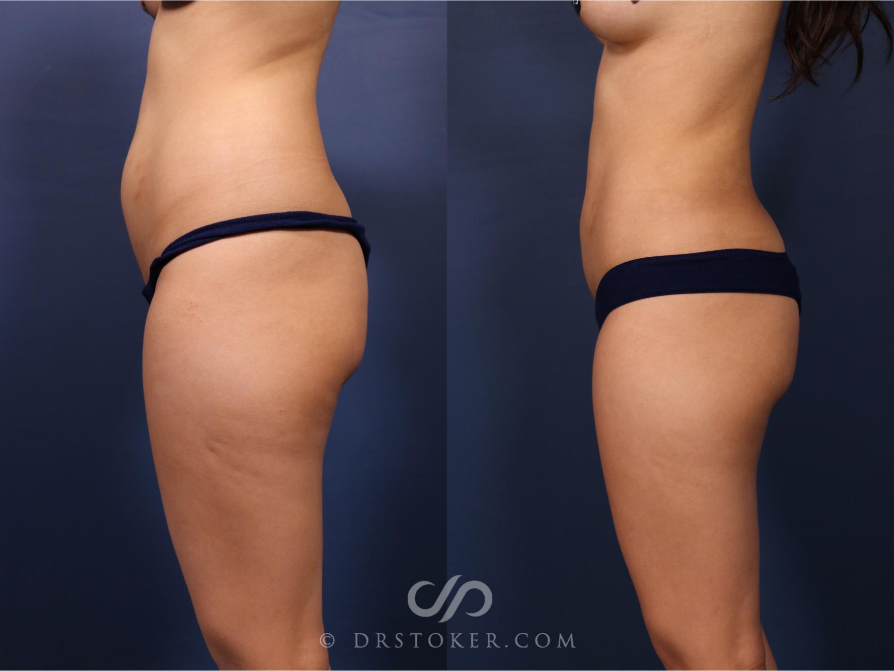 Before & After Liposuction Case 2656 Left Side View in Los Angeles, CA