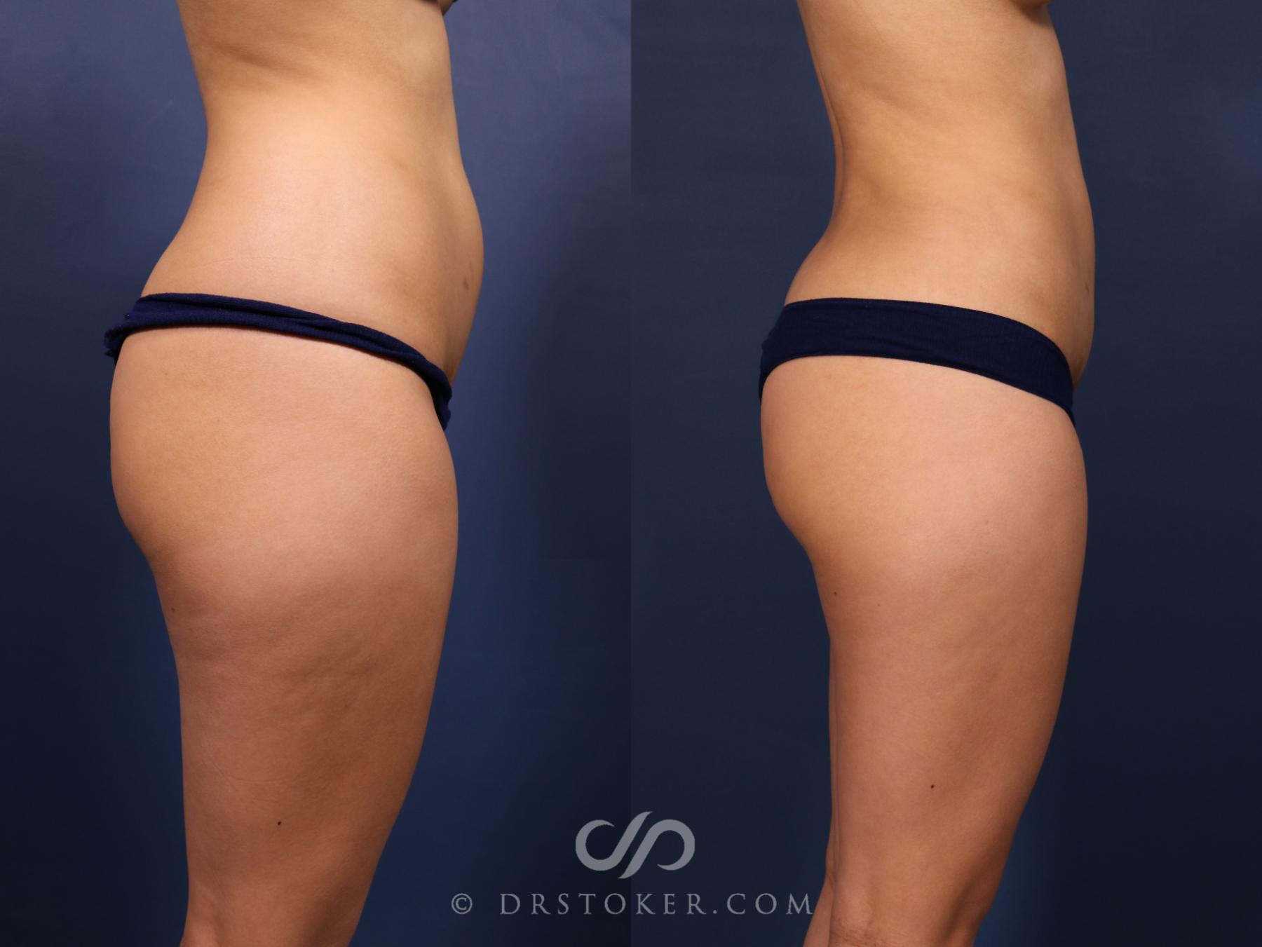 Before & After Liposuction Case 2656 Right Side View in Los Angeles, CA