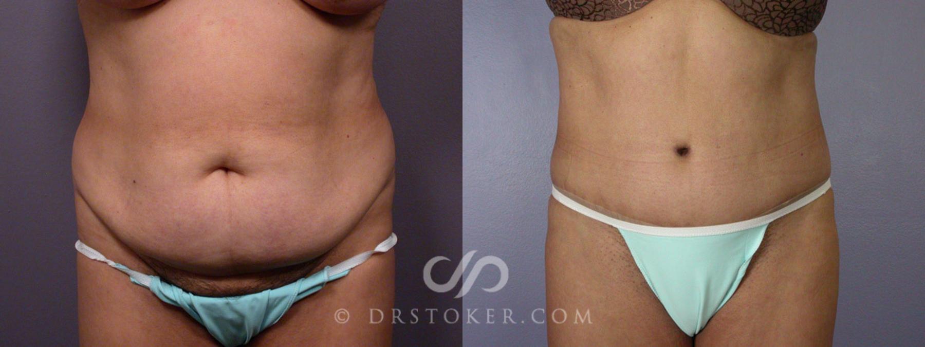 Before & After Liposuction Case 281 View #1 View in Los Angeles, CA