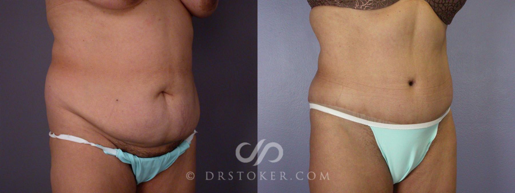 Before & After Tummy Tuck Case 281 View #2 View in Los Angeles, CA