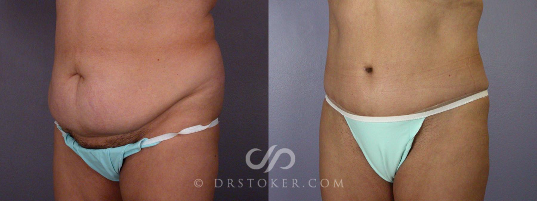 Before & After Liposuction Case 281 View #3 View in Los Angeles, CA