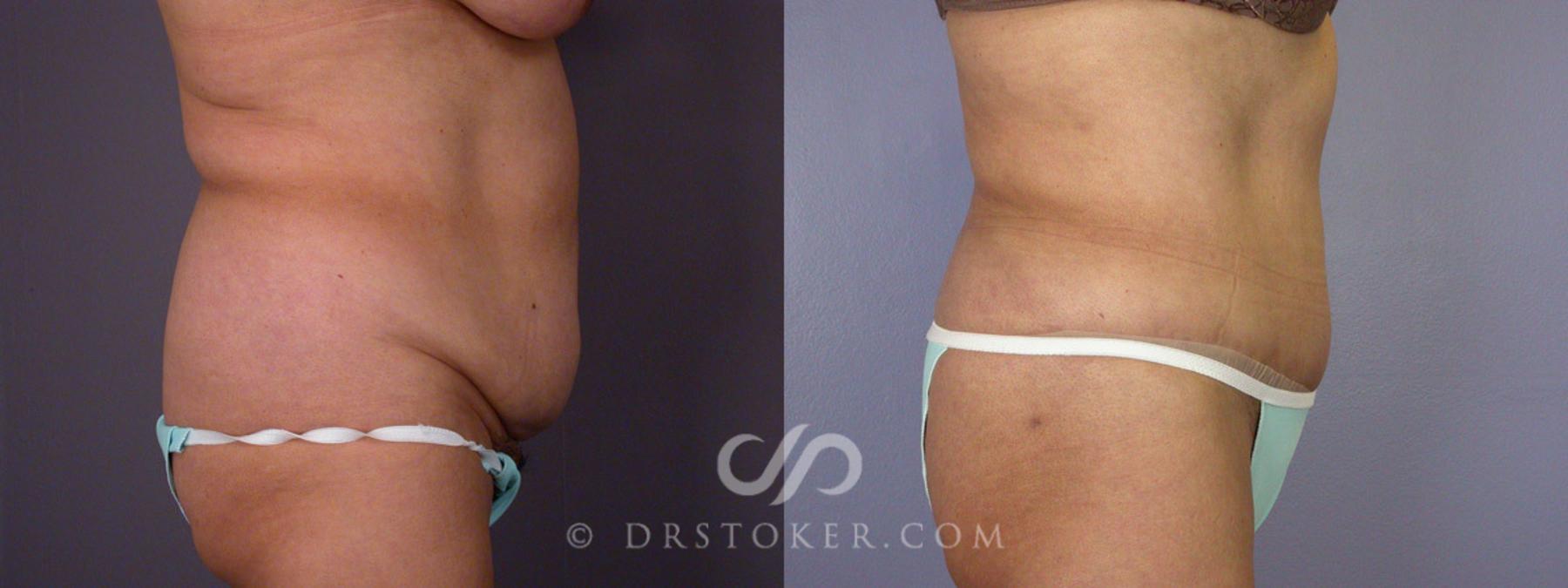 Before & After Tummy Tuck Case 281 View #4 View in Los Angeles, CA