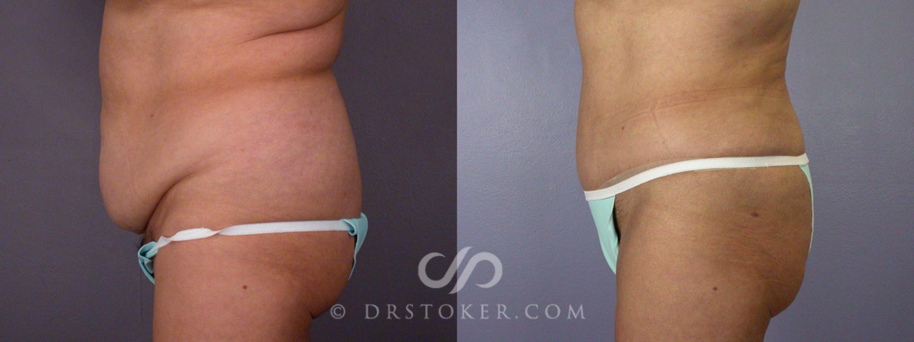 Before & After Tummy Tuck Case 281 View #5 View in Los Angeles, CA
