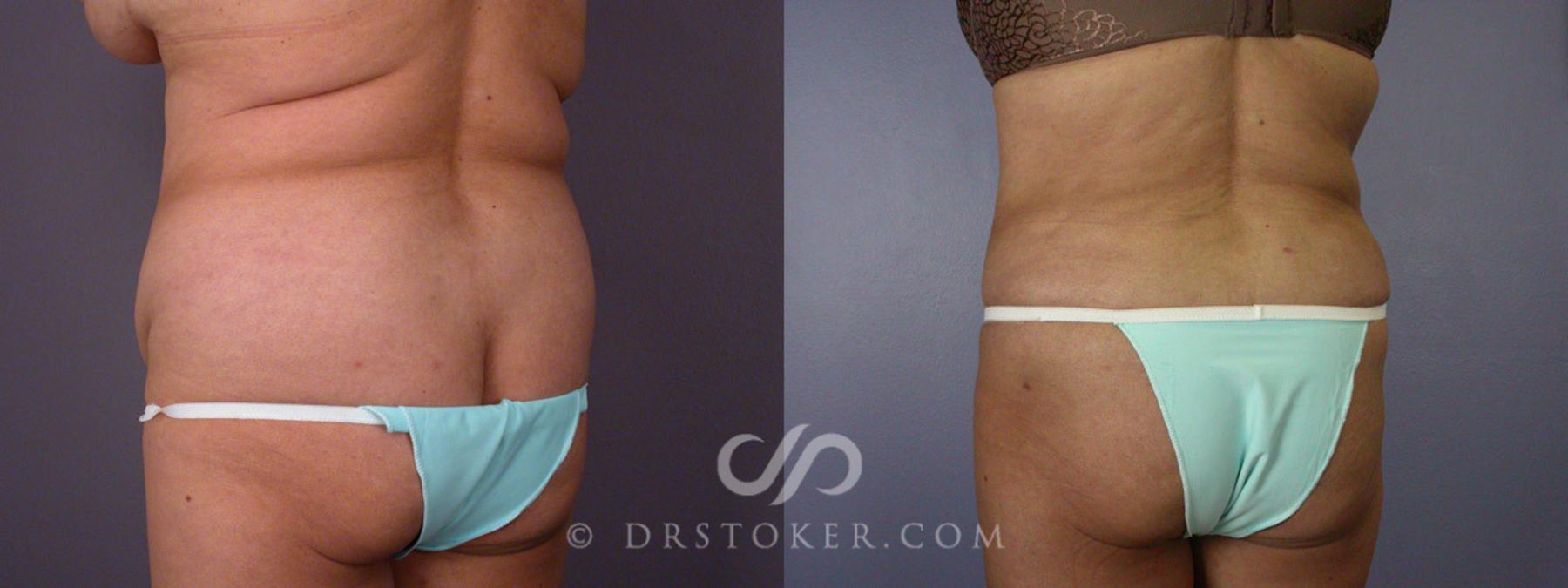 Before & After Liposuction Case 281 View #7 View in Los Angeles, CA