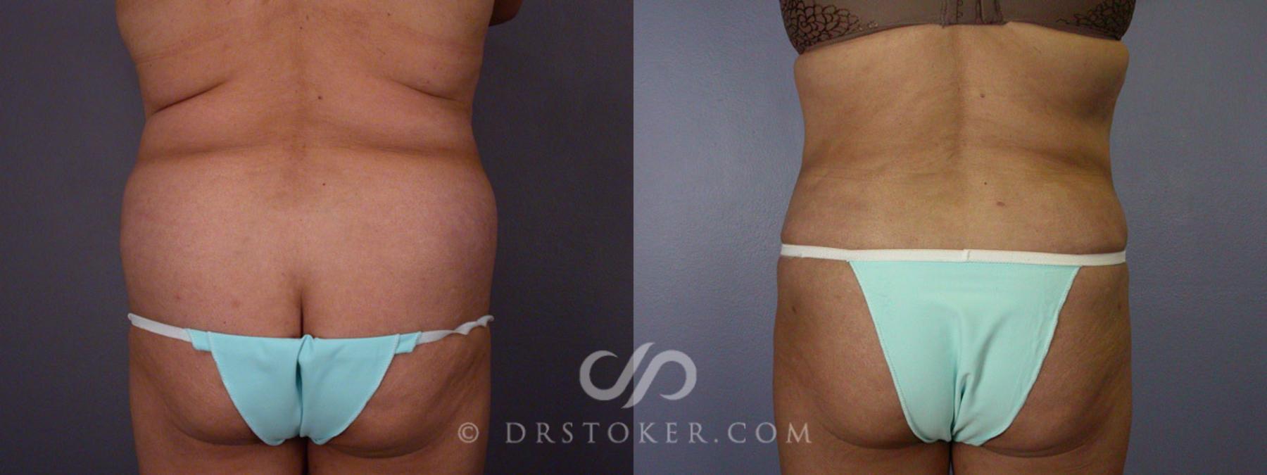Before & After Liposuction Case 281 View #8 View in Los Angeles, CA