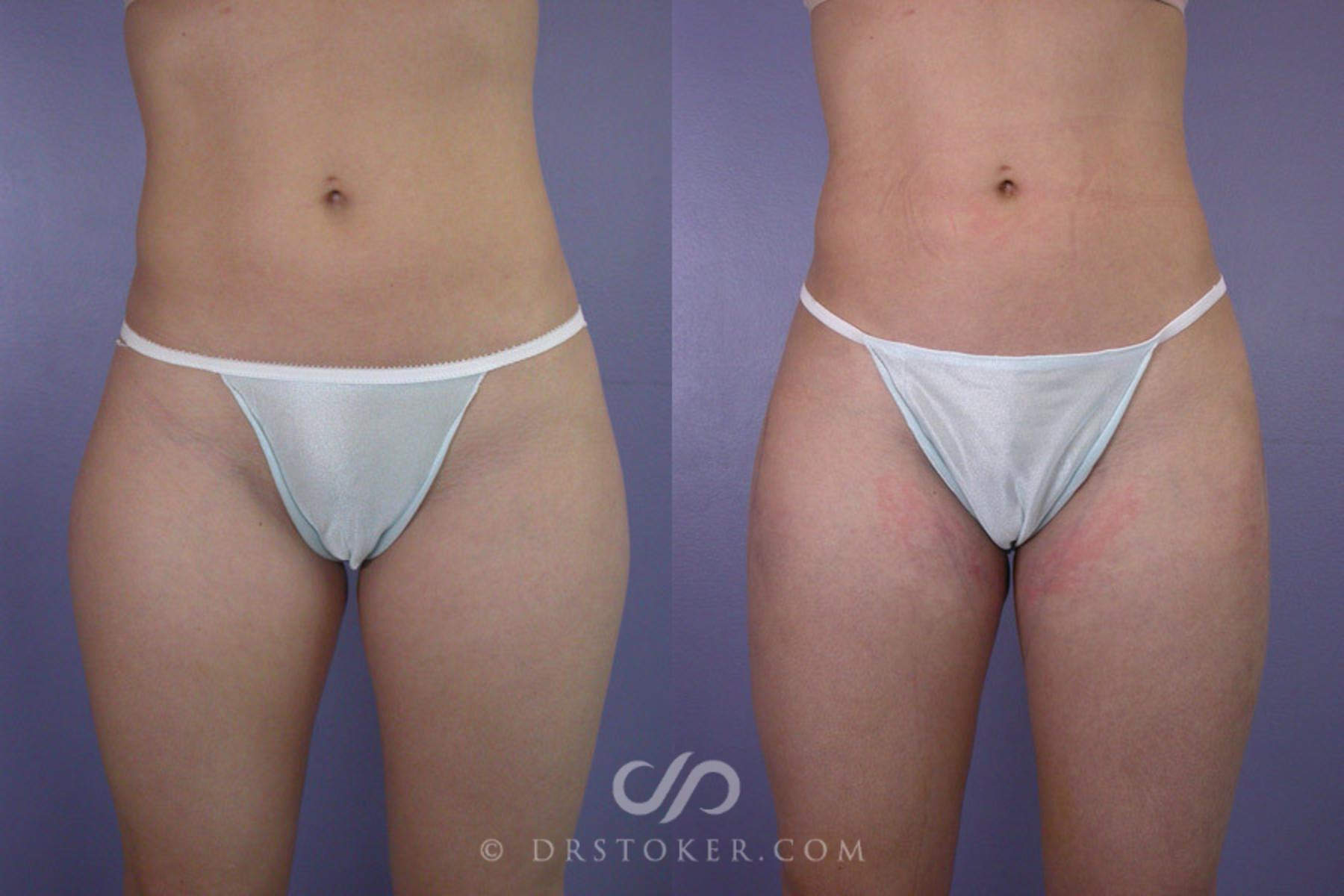 Before & After Liposuction Case 287 View #1 View in Los Angeles, CA