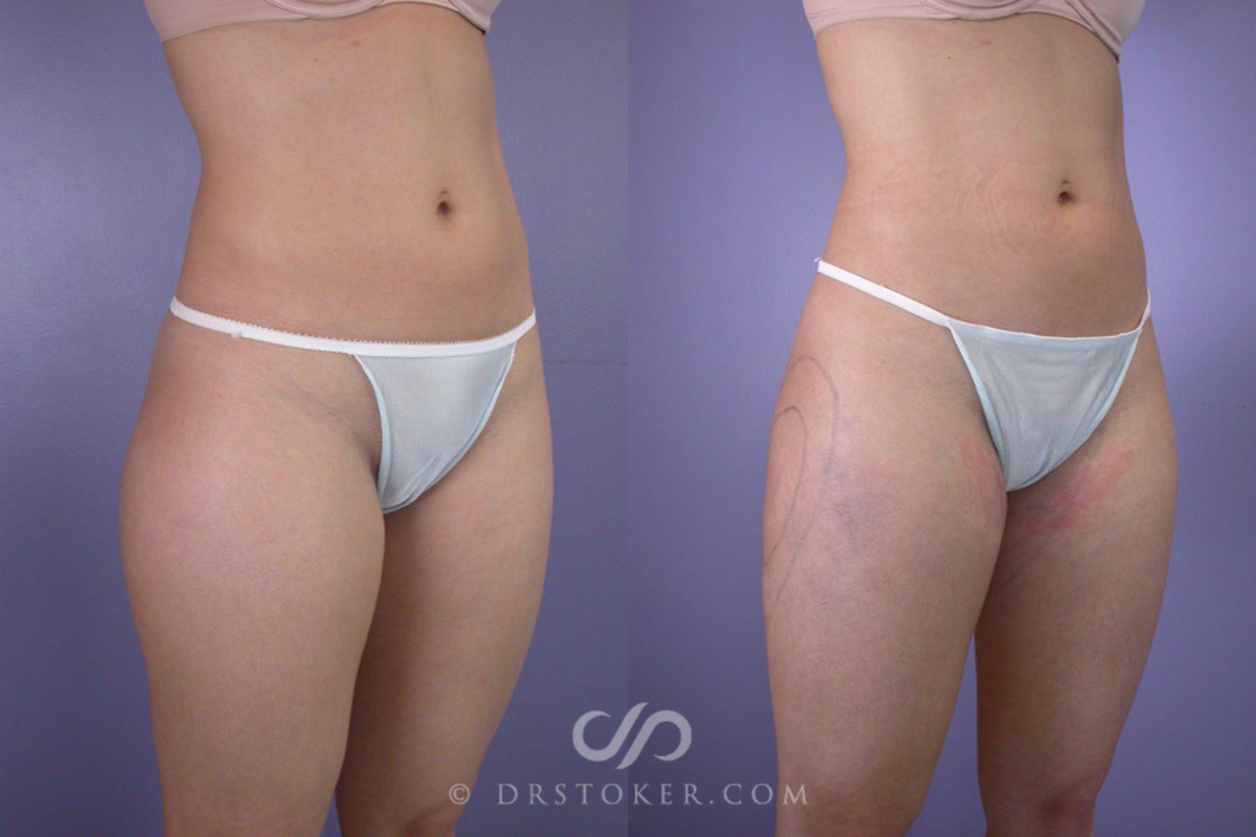 Before & After Liposuction Case 287 View #2 View in Los Angeles, CA