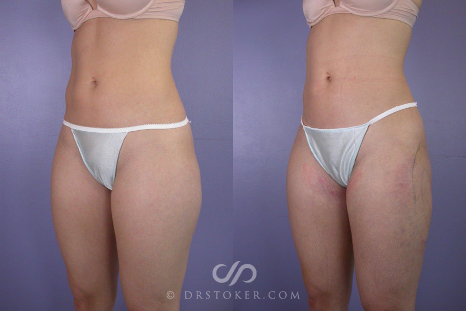Before & After Liposuction Case 287 View #3 View in Los Angeles, CA