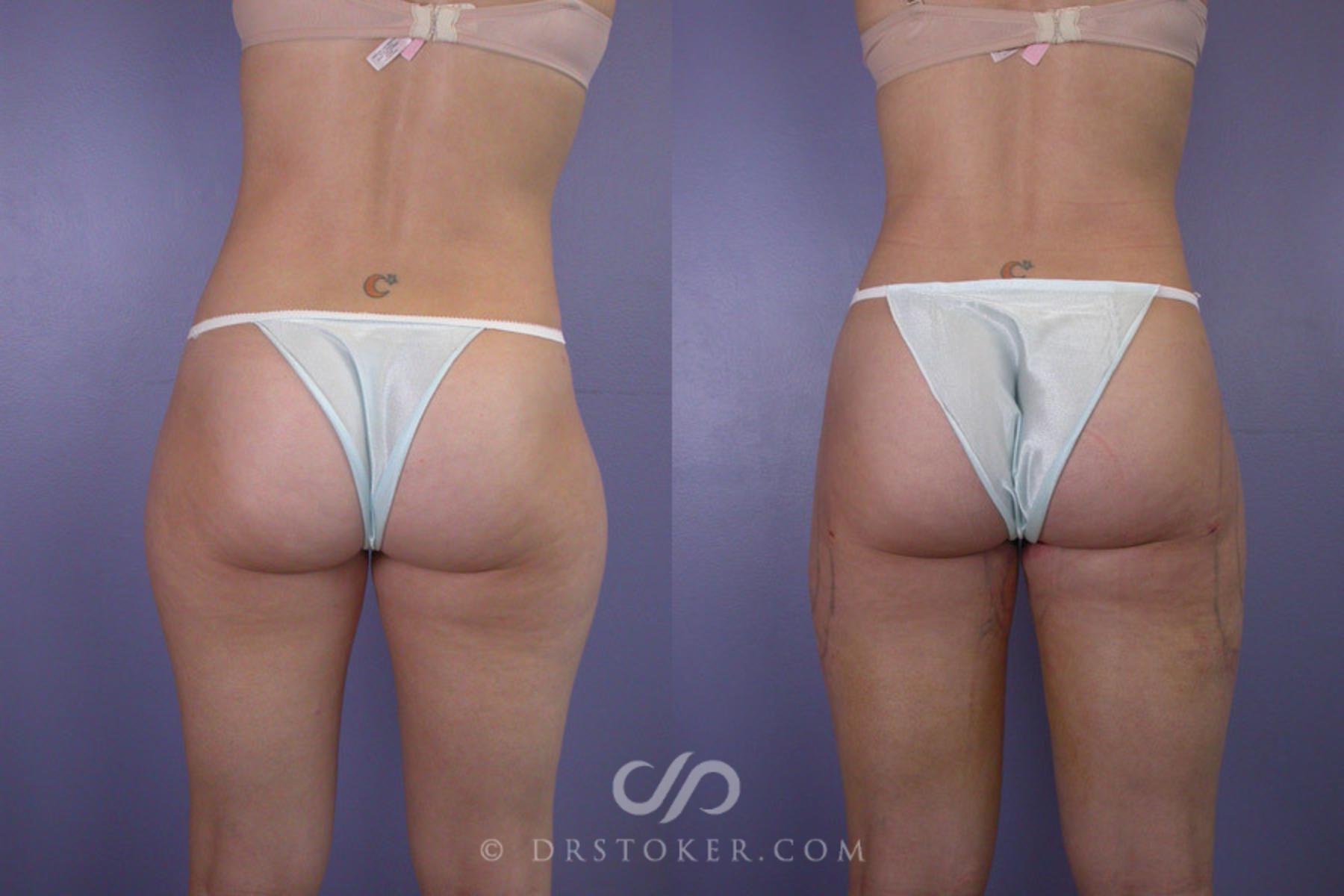 Before & After Liposuction Case 287 View #4 View in Los Angeles, CA