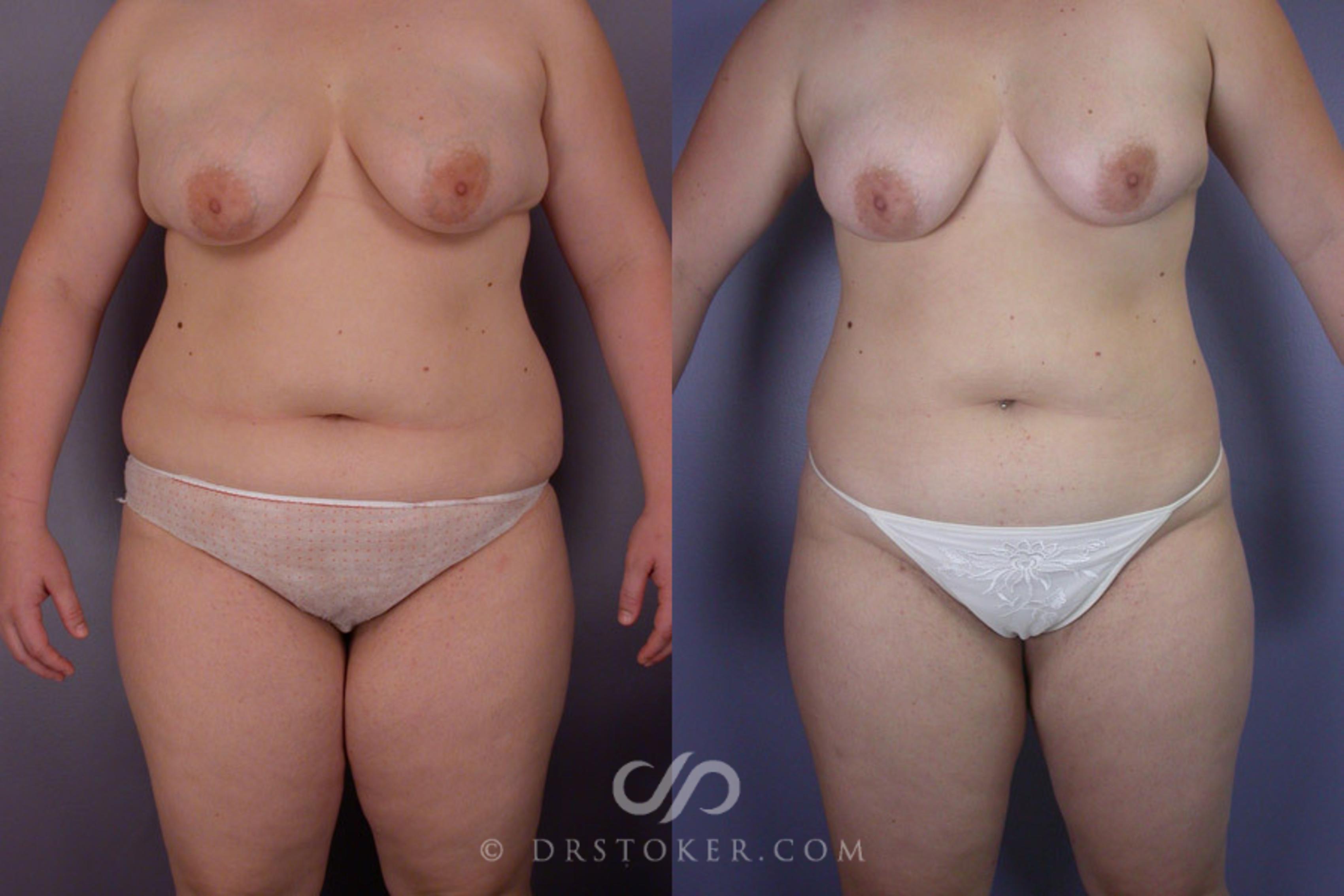 Before & After Liposuction Case 288 View #1 View in Los Angeles, CA