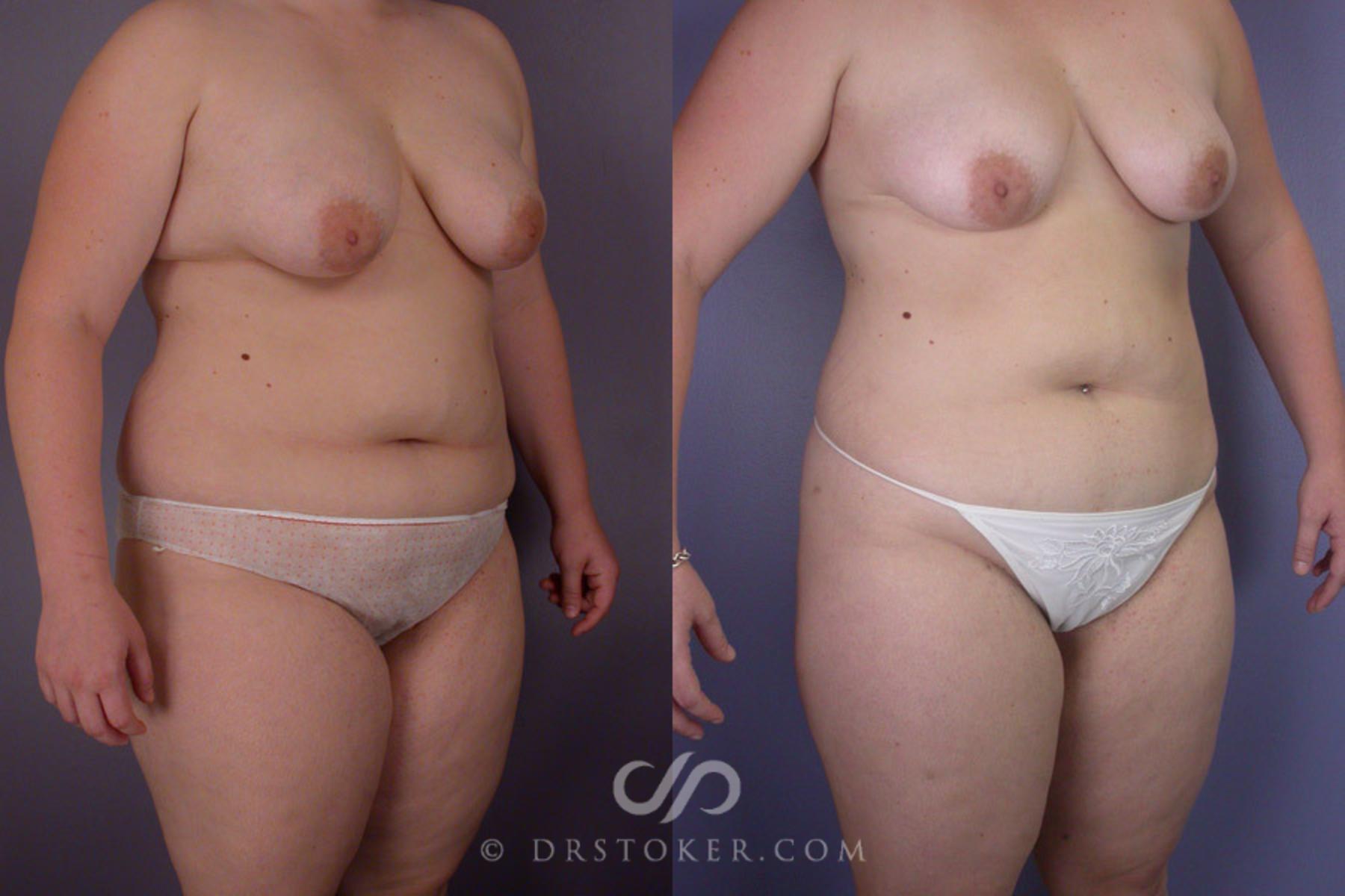 Before & After Liposuction Case 288 View #2 View in Los Angeles, CA
