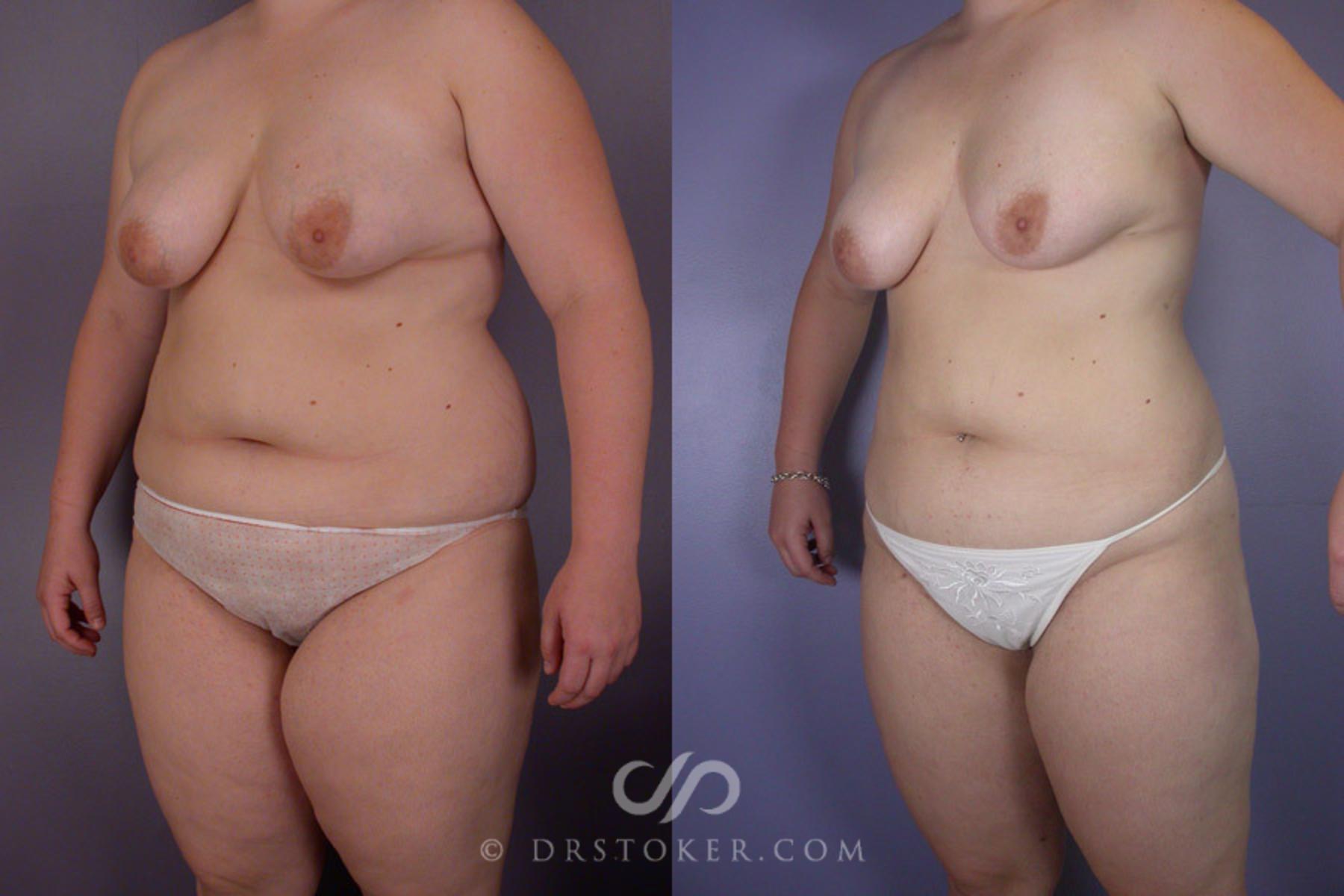 Before & After Liposuction Case 288 View #3 View in Los Angeles, CA