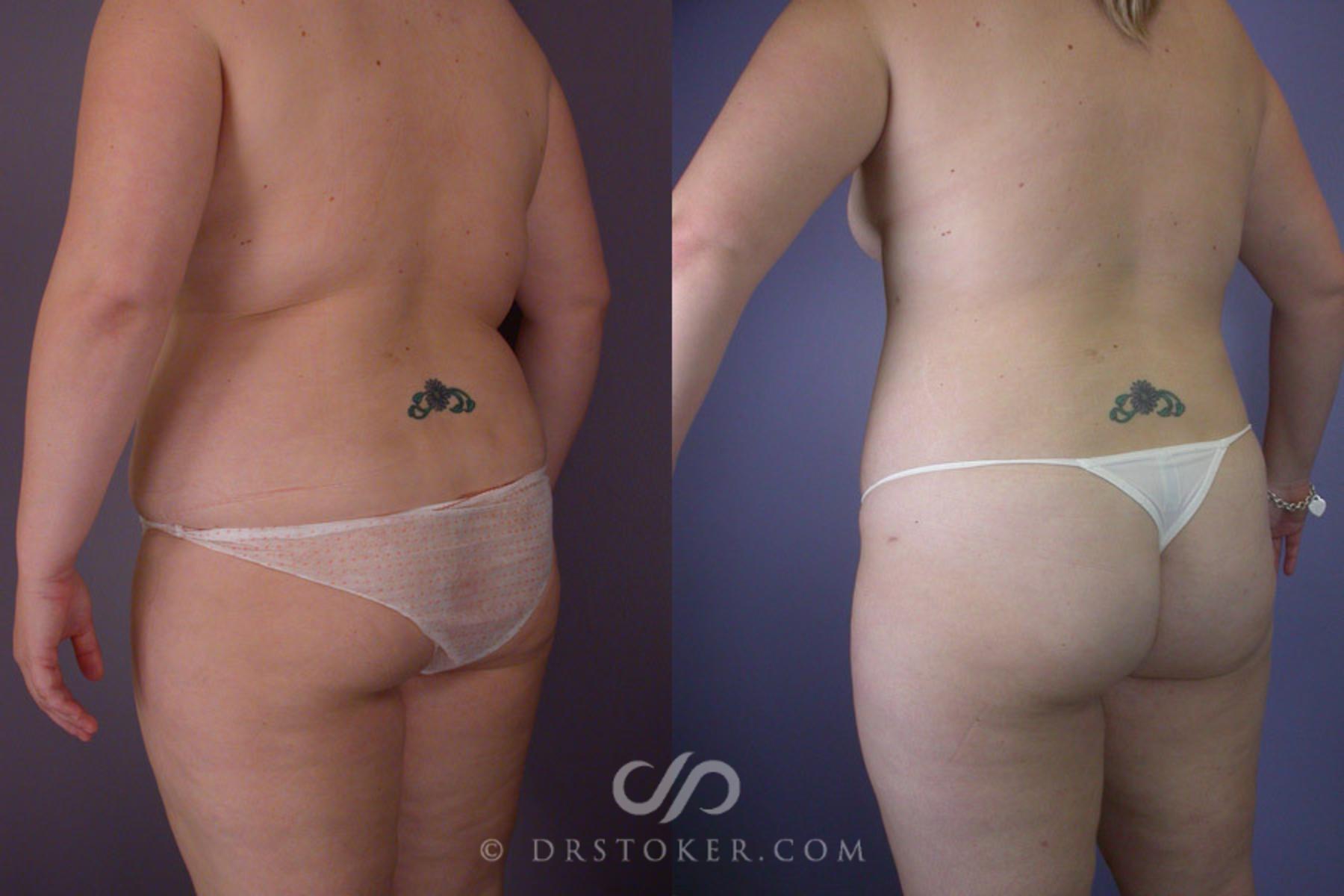 Before & After Liposuction Case 288 View #4 View in Los Angeles, CA