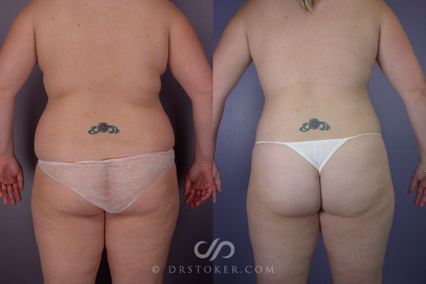 Before & After Liposuction Case 288 View #5 View in Los Angeles, CA