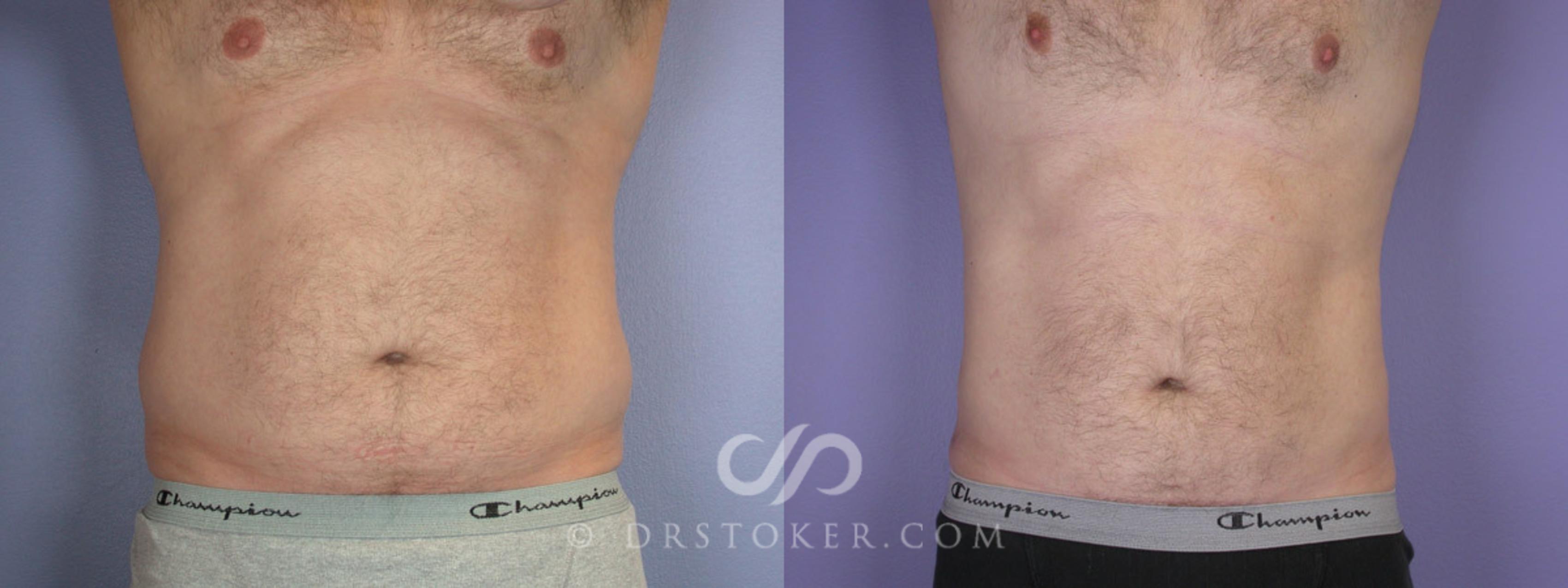 Before & After Liposuction Case 289 View #1 View in Los Angeles, CA