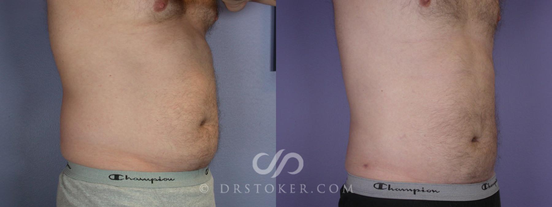 Before & After Liposuction Case 289 View #2 View in Los Angeles, CA