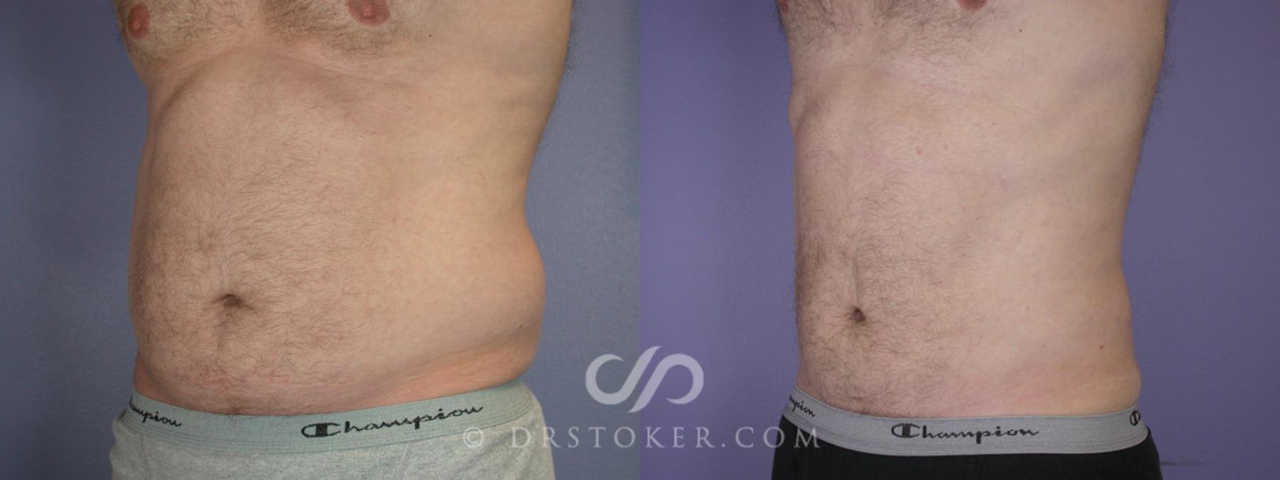 Before & After Liposuction for Men Case 289 View #3 View in Los Angeles, CA