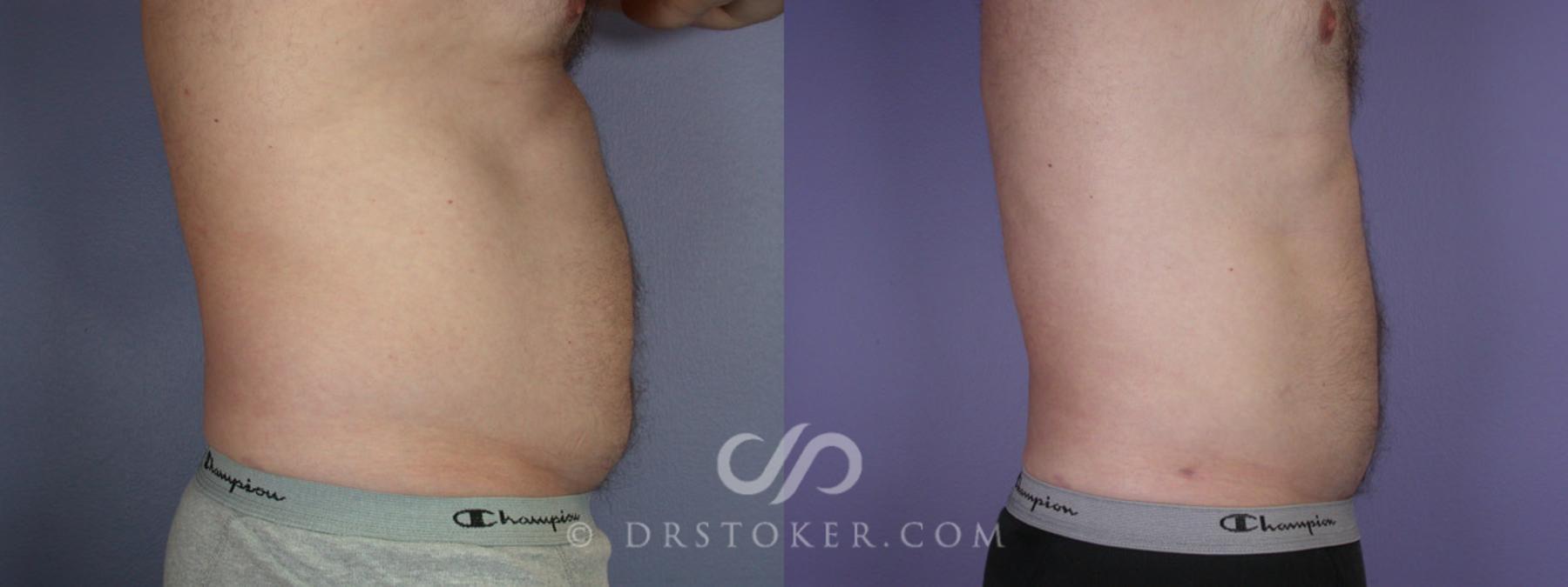 Before & After Liposuction for Men Case 289 View #4 View in Los Angeles, CA