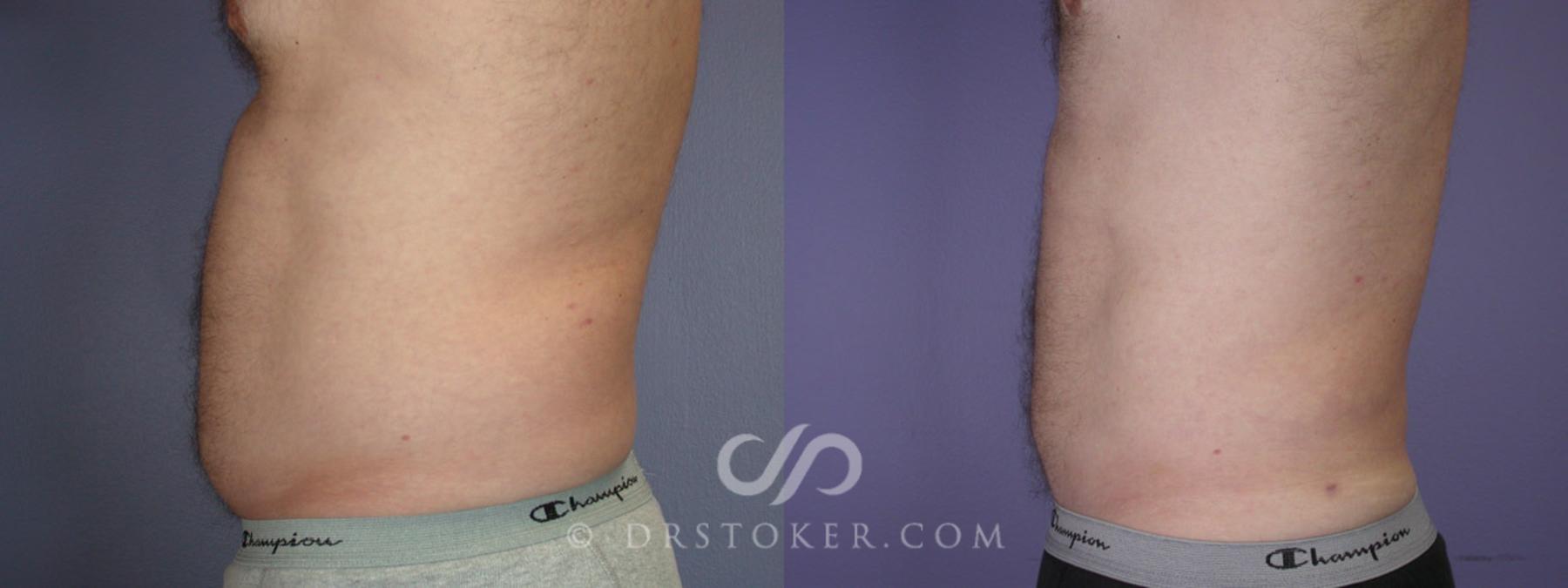 Before & After Liposuction Case 289 View #5 View in Los Angeles, CA