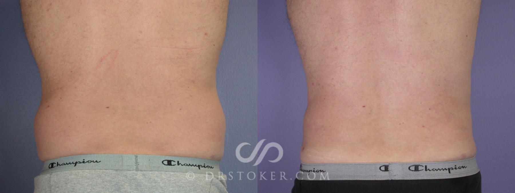 Before & After Liposuction for Men Case 289 View #6 View in Los Angeles, CA