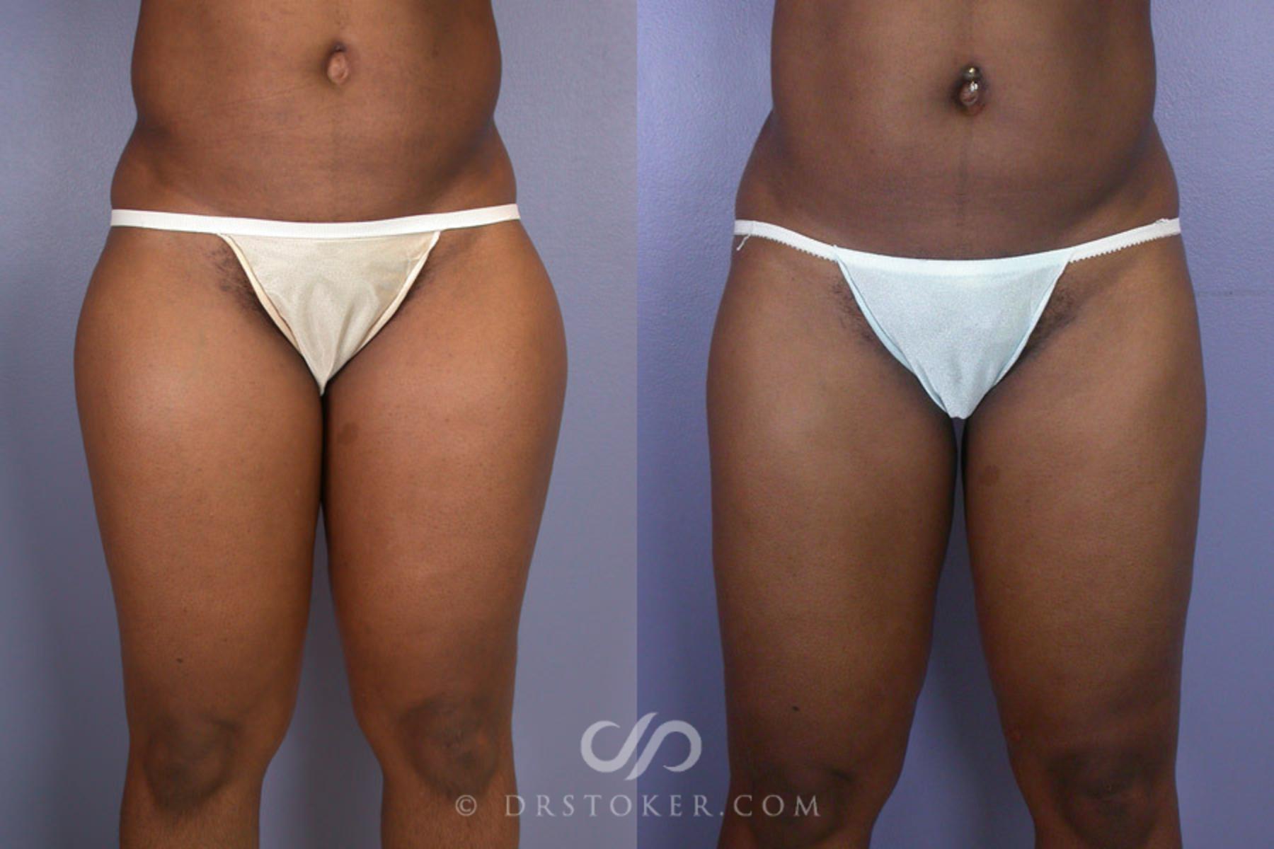 Before & After Liposuction Case 315 View #1 View in Los Angeles, CA
