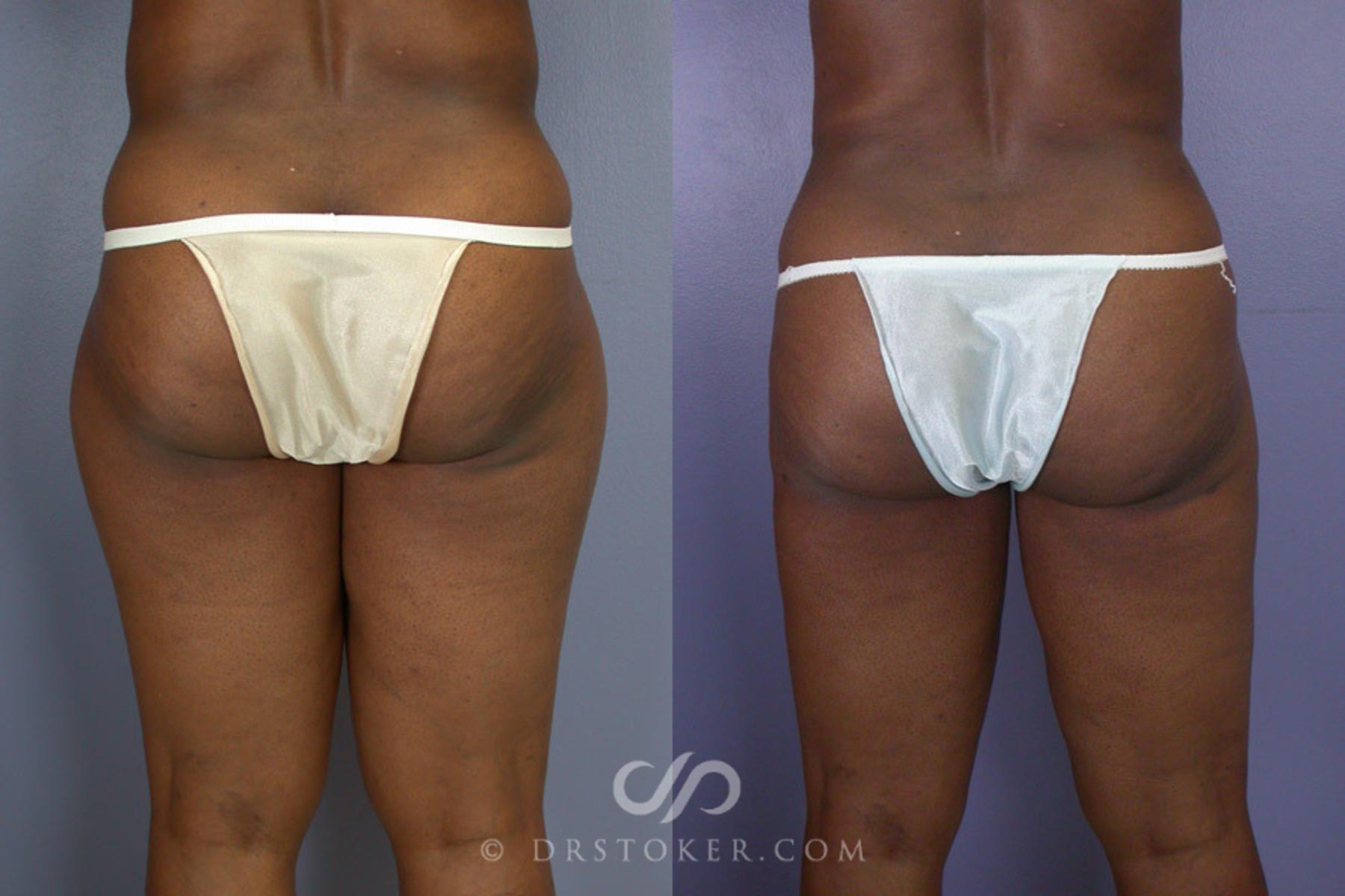 Before & After Liposuction Case 315 View #2 View in Los Angeles, CA