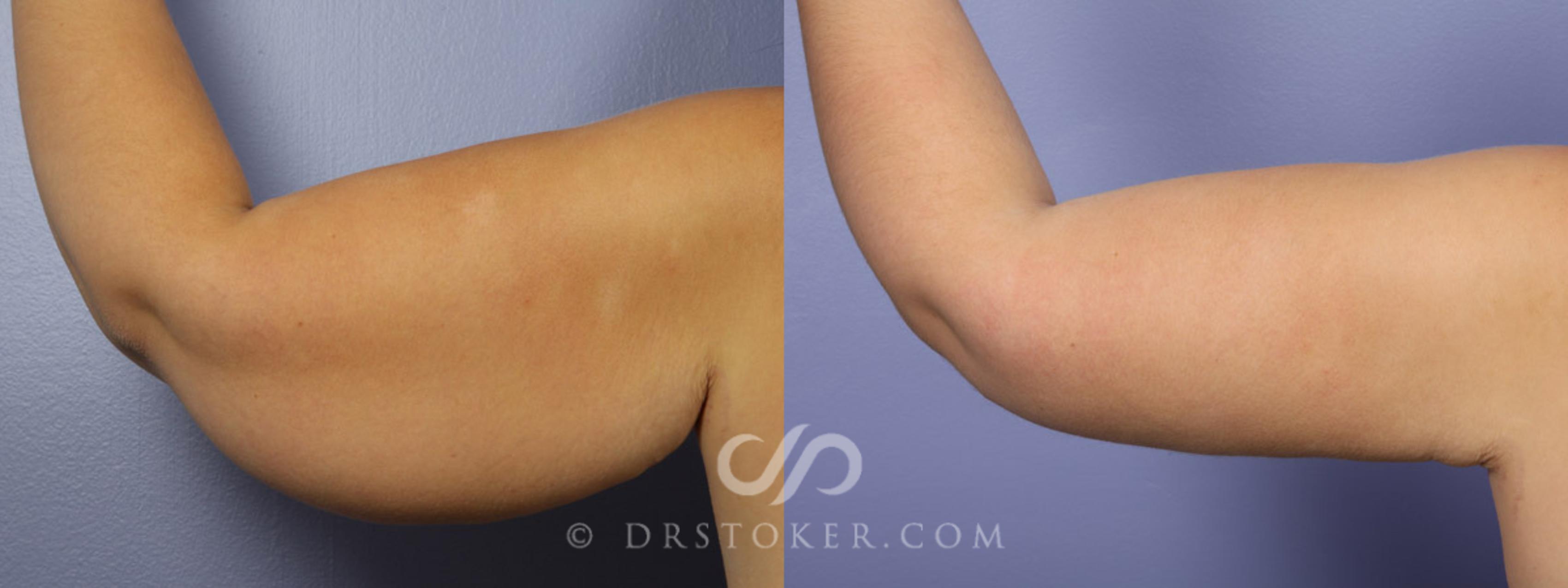 Before & After Arm Lift Case 342 View #1 View in Los Angeles, CA