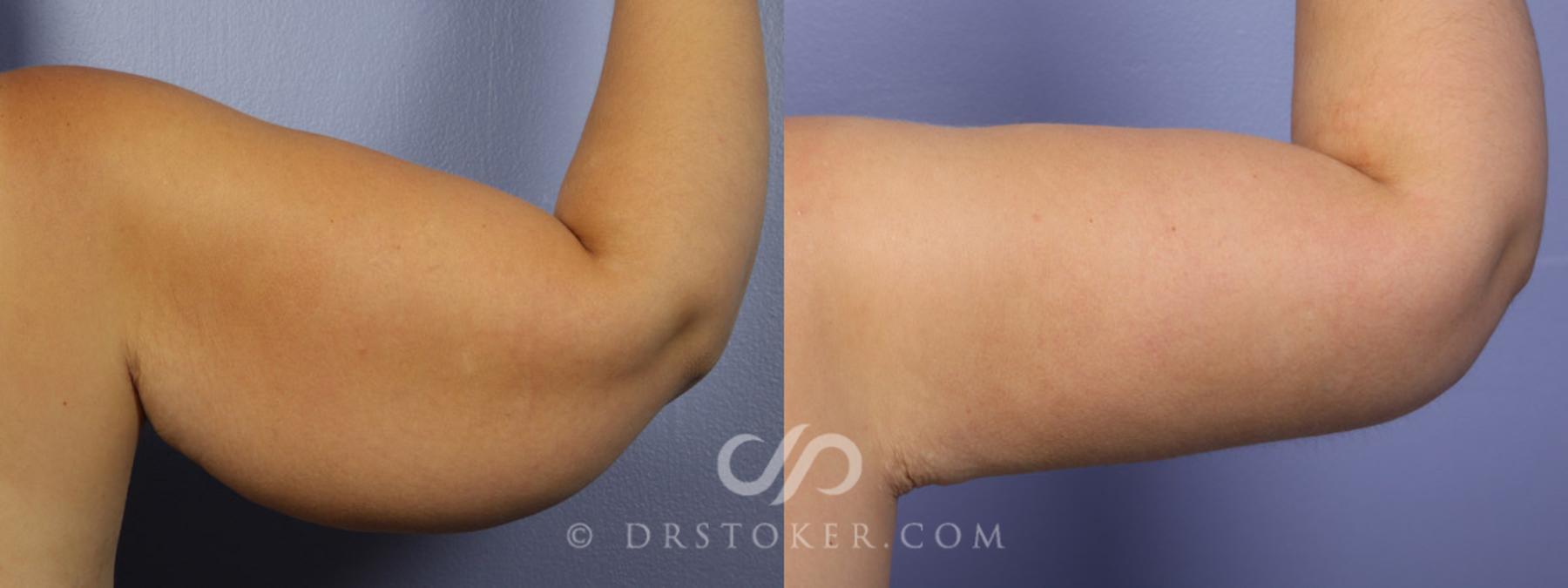 Before & After Liposuction Case 342 View #2 View in Los Angeles, CA