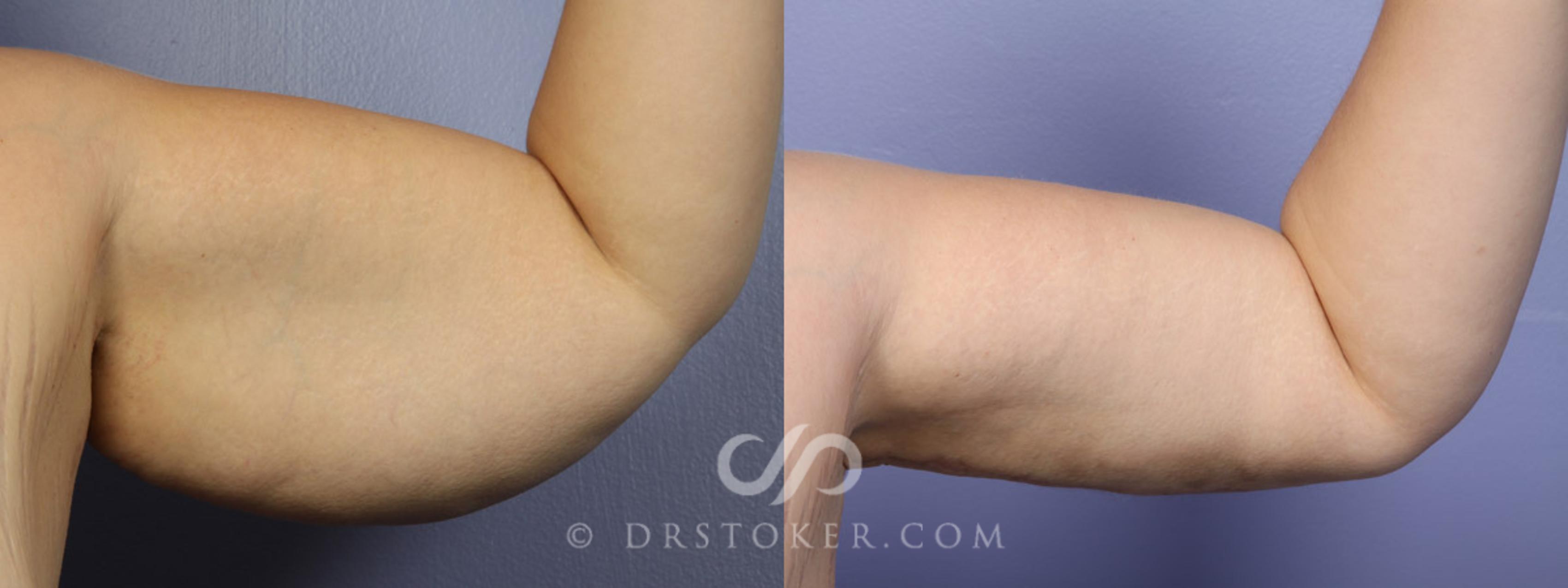 Before & After Liposuction Case 342 View #3 View in Los Angeles, CA