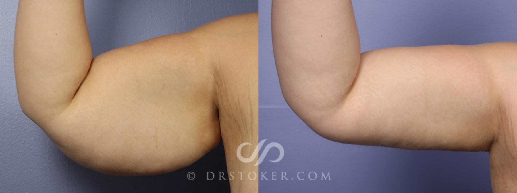 Before & After Liposuction Case 342 View #4 View in Los Angeles, CA