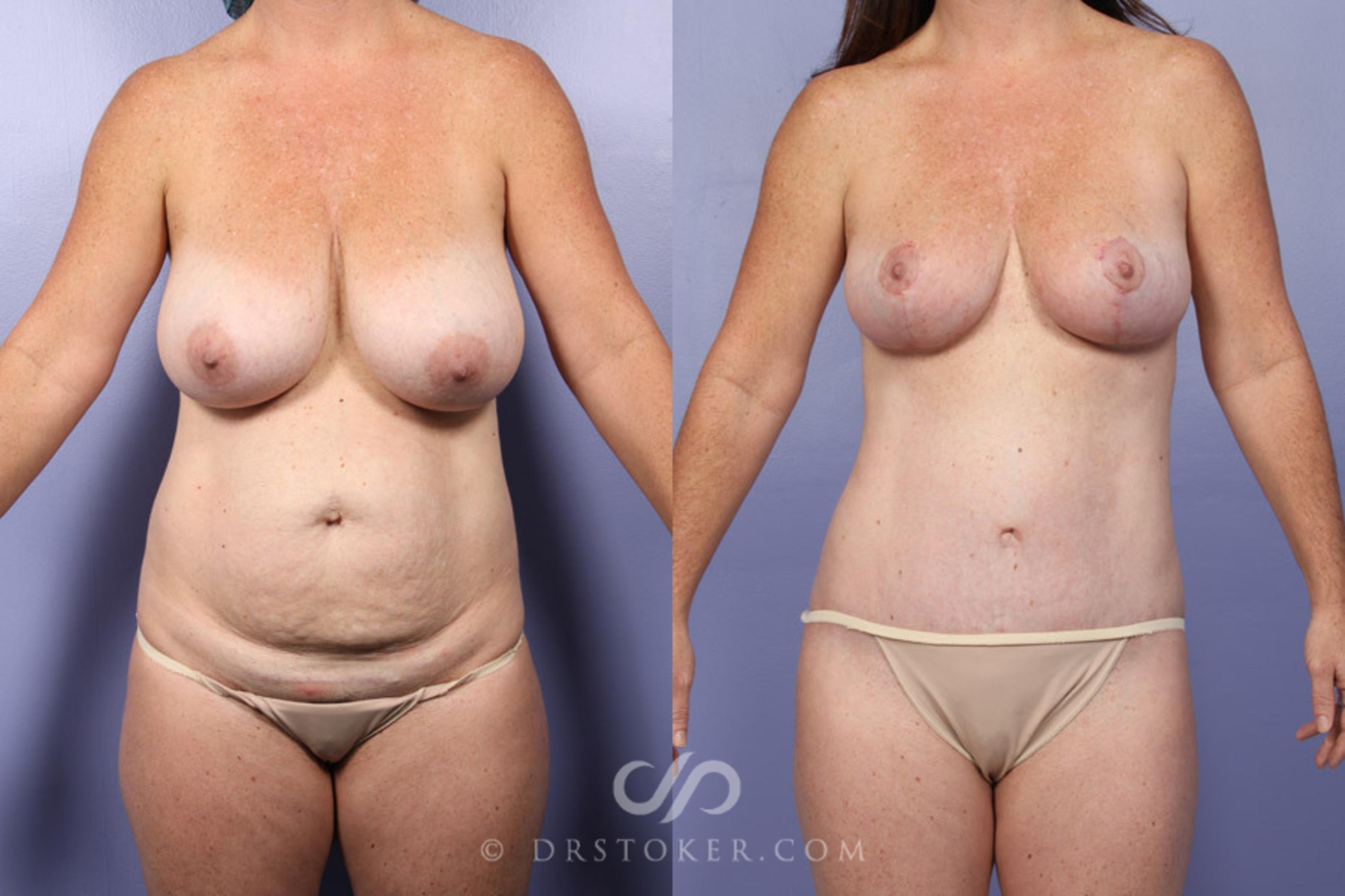 Before & After Mommy Makeover Case 343 View #1 View in Marina del Rey, CA