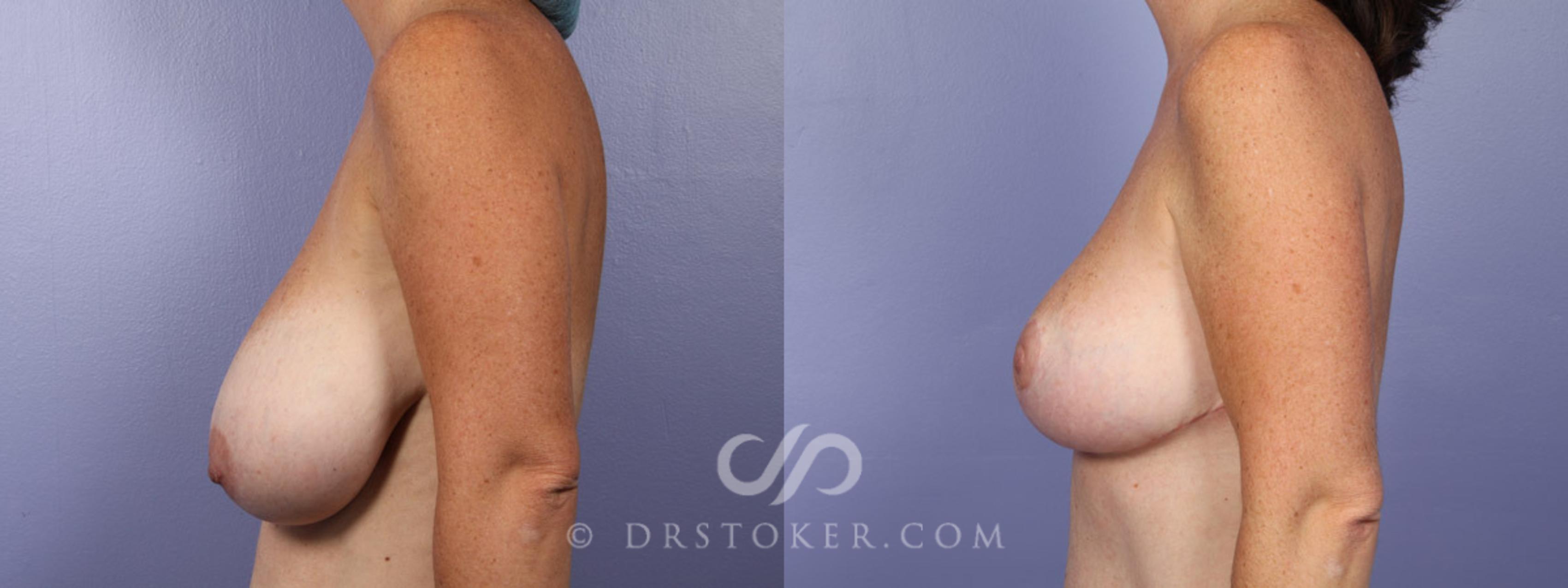 Before & After Liposuction Case 343 View #10 View in Los Angeles, CA