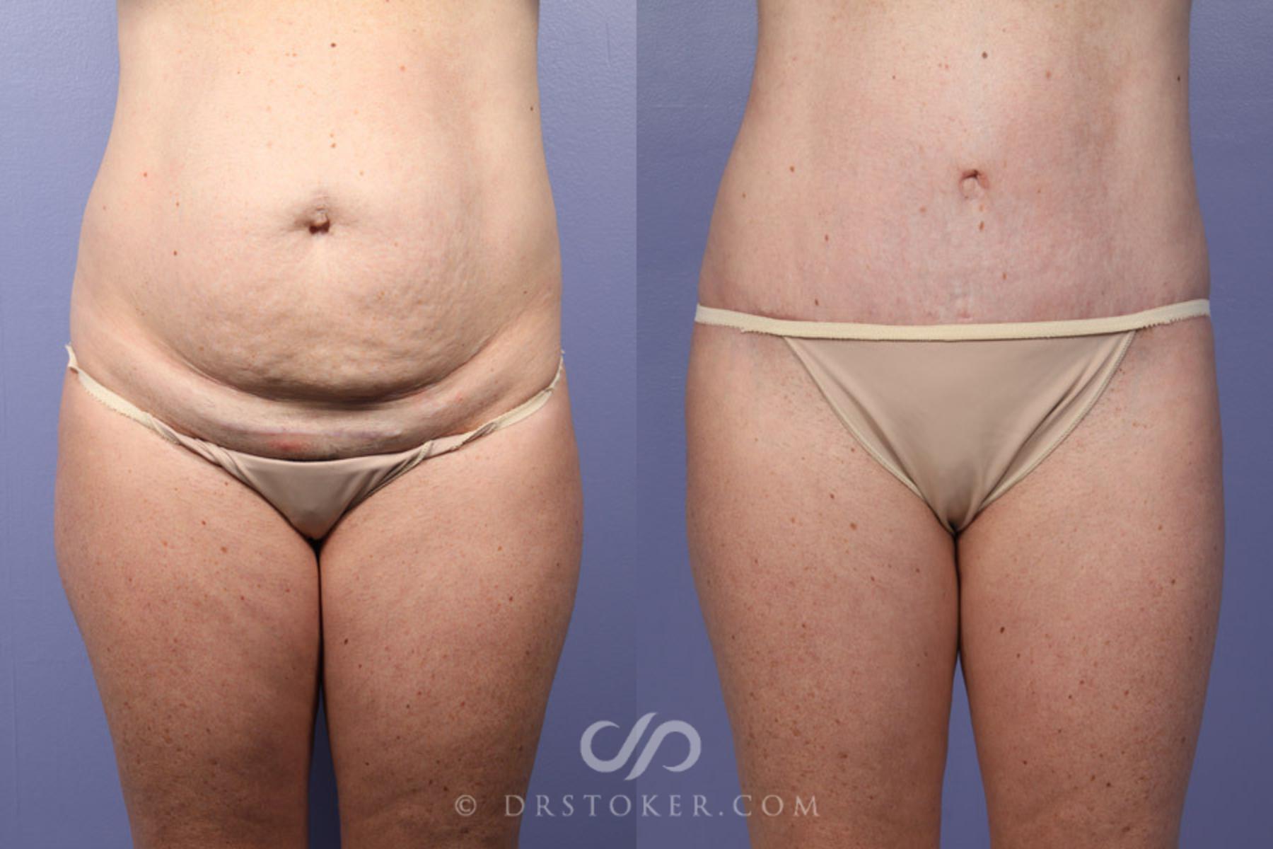Before & After Breast Reduction (for Women) Case 343 View #11 View in Los Angeles, CA
