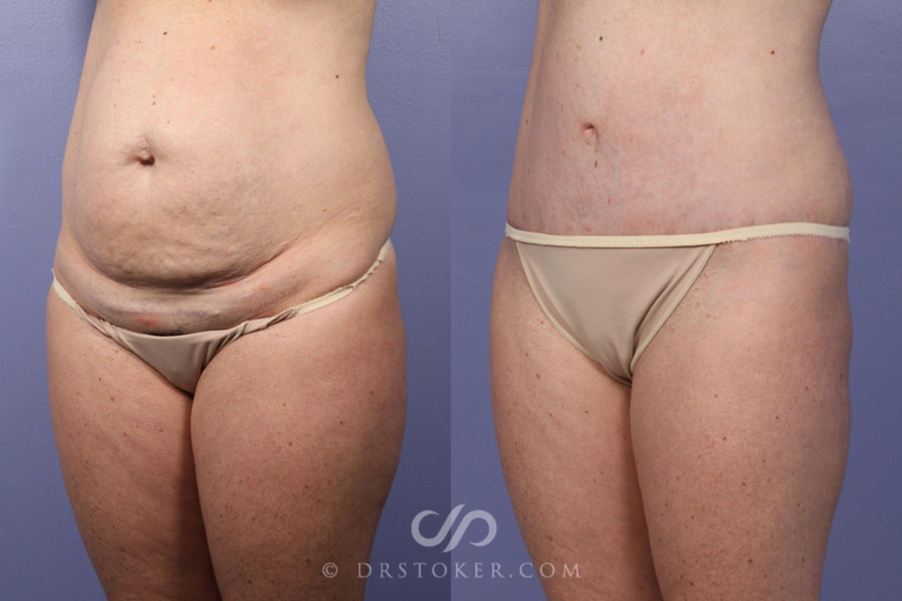 Before & After Tummy Tuck Case 343 View #12 View in Los Angeles, CA
