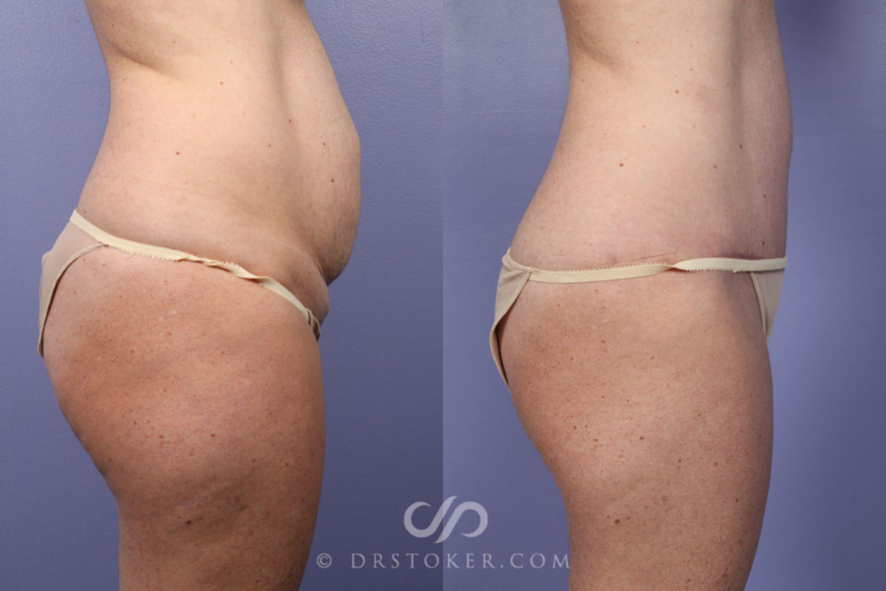 Before & After Breast Lift Case 343 View #13 View in Los Angeles, CA